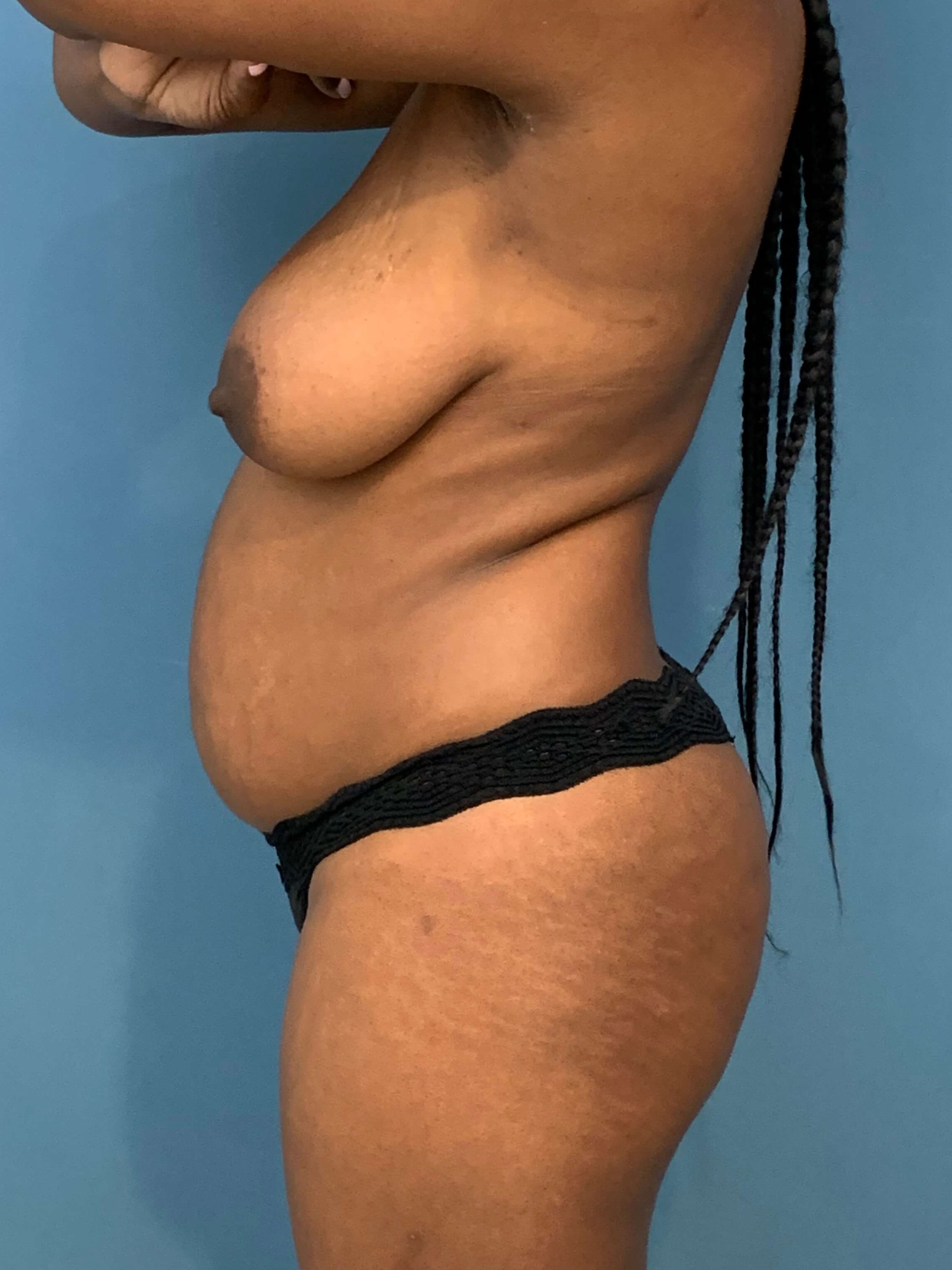 Full Abdominoplasty with Deep Muscle Plication and Liposuction of Bilateral Flanks, before, view 2