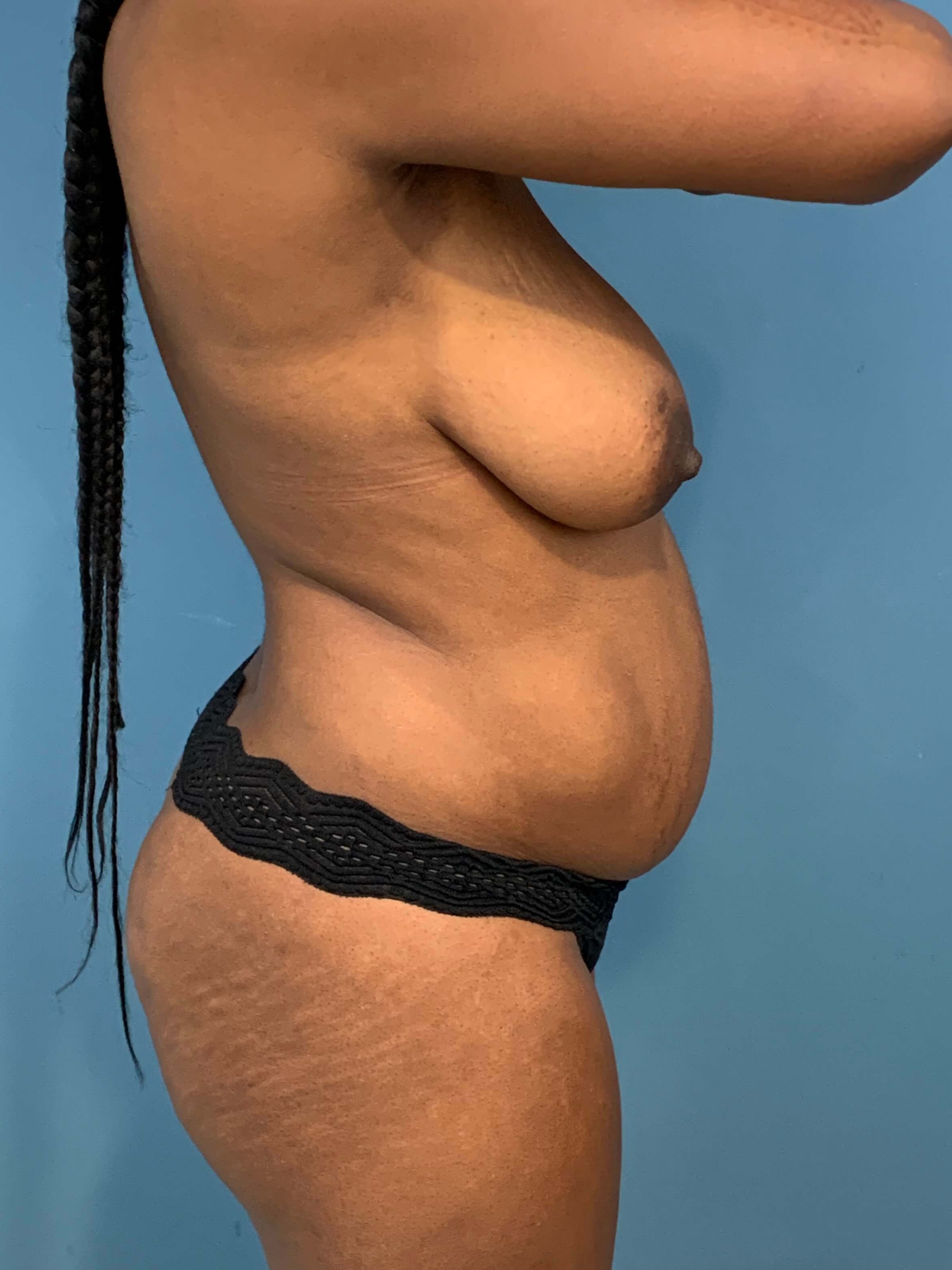 Full Abdominoplasty with Deep Muscle Plication and Liposuction of Bilateral Flanks, before, view 3