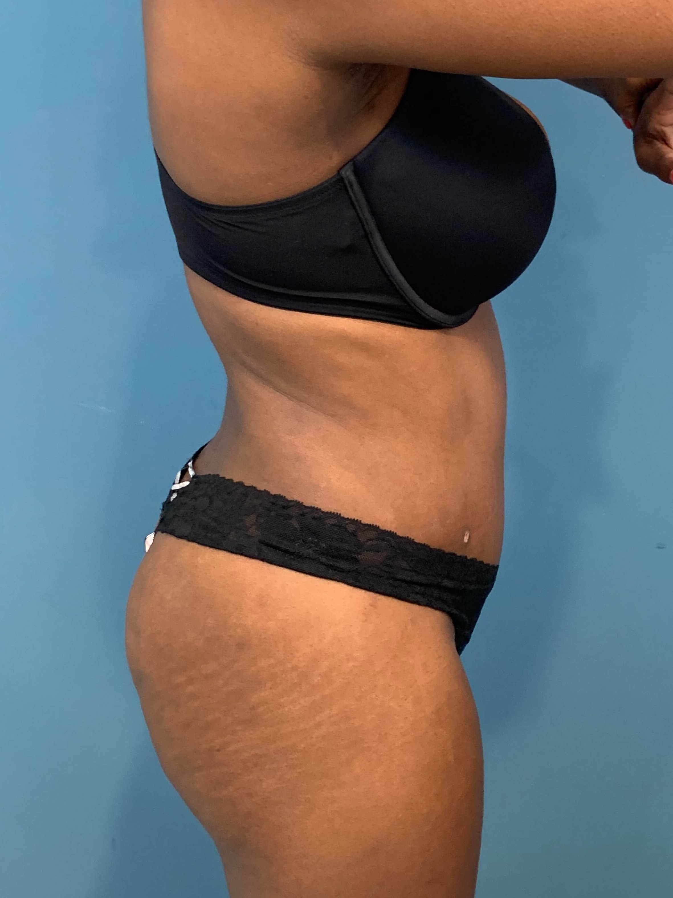 Full Abdominoplasty with Deep Muscle Plication and Liposuction of Bilateral Flanks, after, view 3