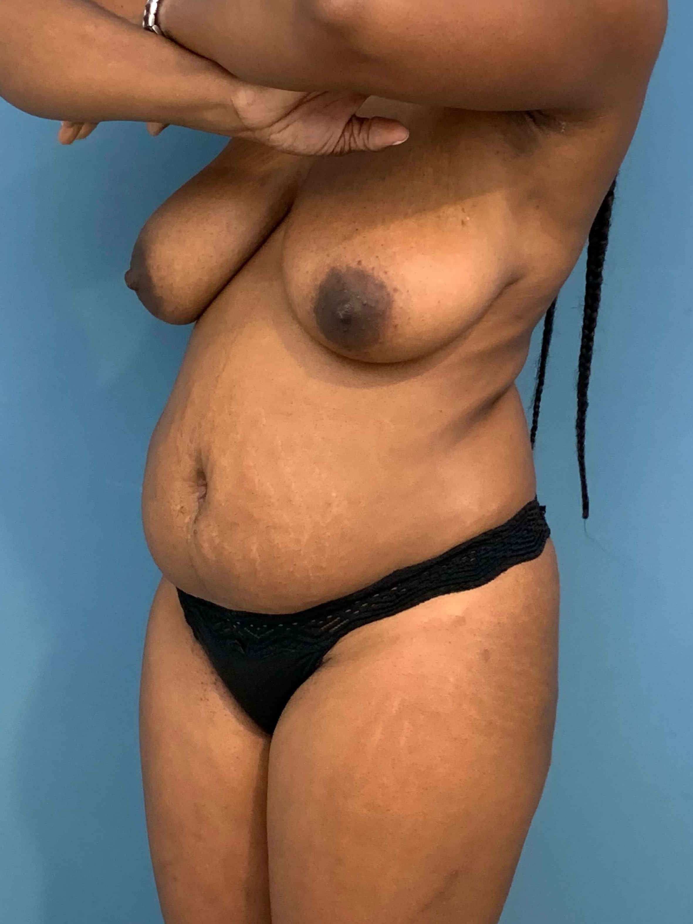Full Abdominoplasty with Deep Muscle Plication and Liposuction of Bilateral Flanks, before, view 4
