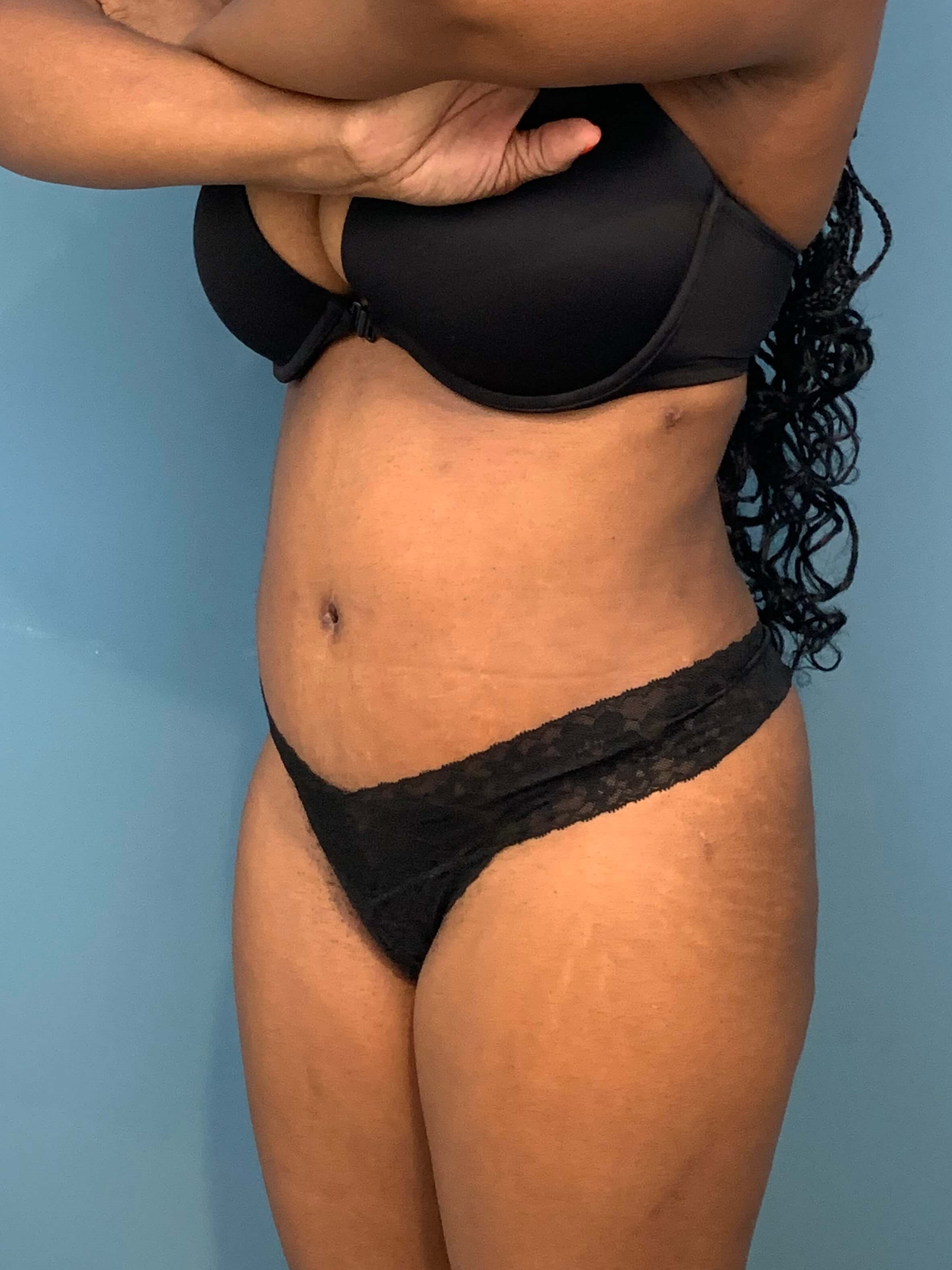 Full Abdominoplasty with Deep Muscle Plication and Liposuction of Bilateral Flanks, after, view 4