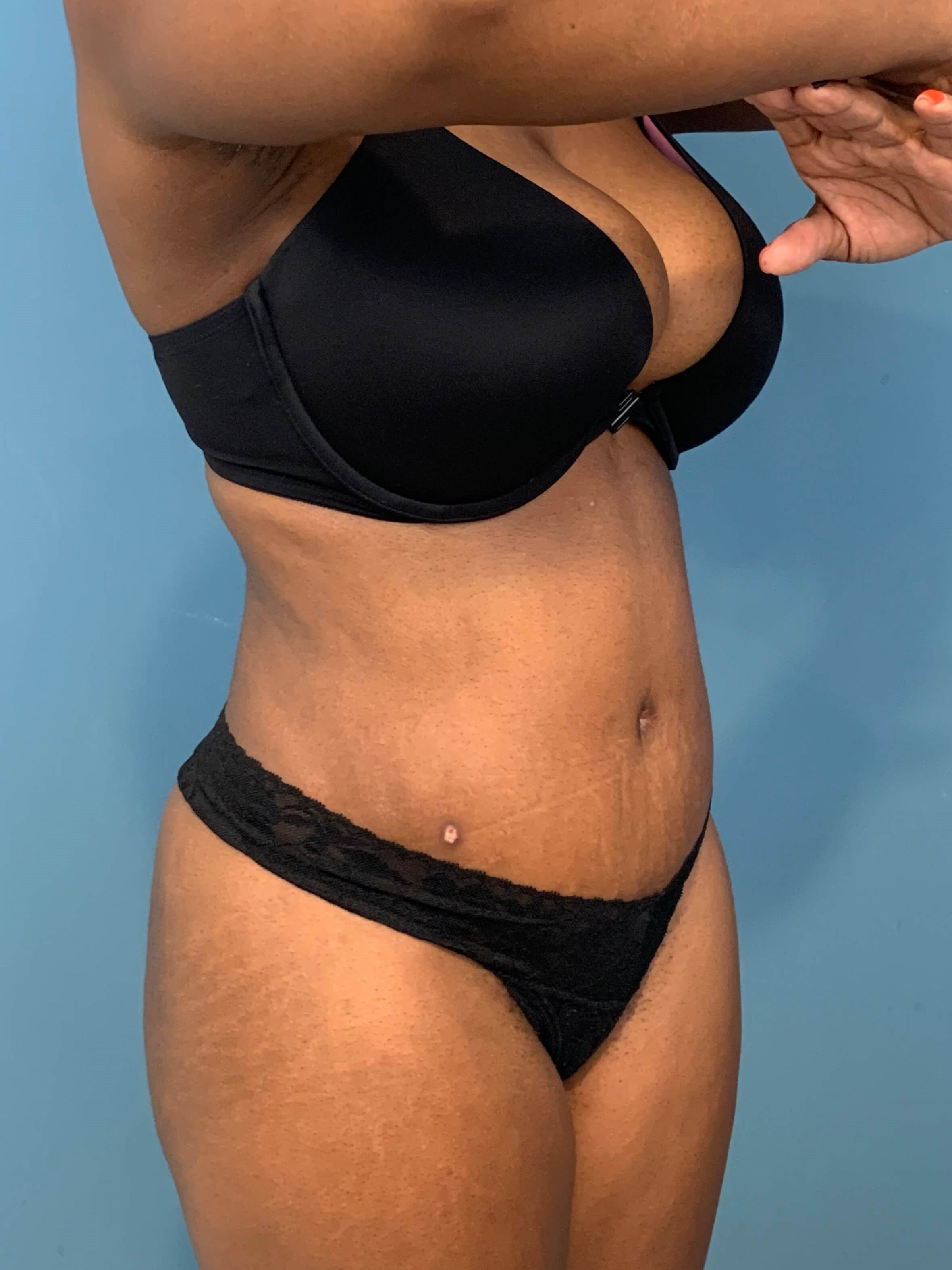 Full Abdominoplasty with Deep Muscle Plication and Liposuction of Bilateral Flanks, after, view 5