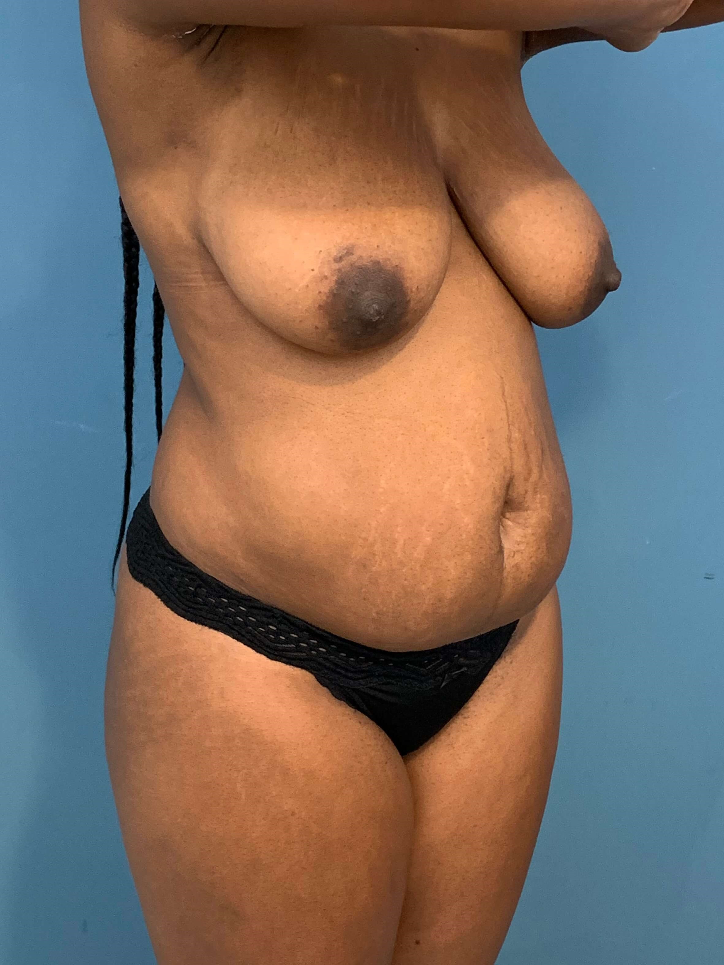 Full Abdominoplasty with Deep Muscle Plication and Liposuction of Bilateral Flanks, before, view 5