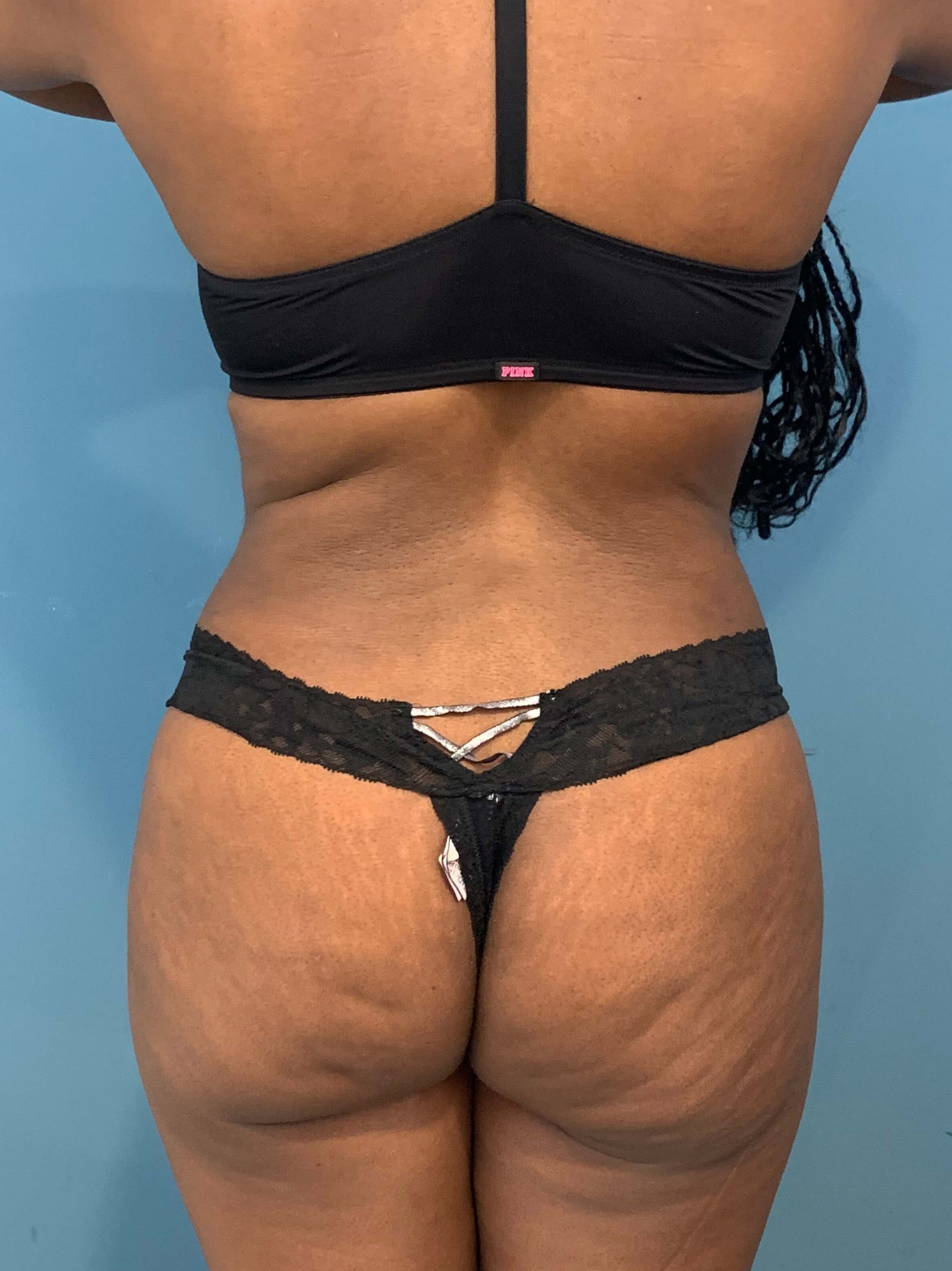 Full Abdominoplasty with Deep Muscle Plication and Liposuction of Bilateral Flanks, after, view 6
