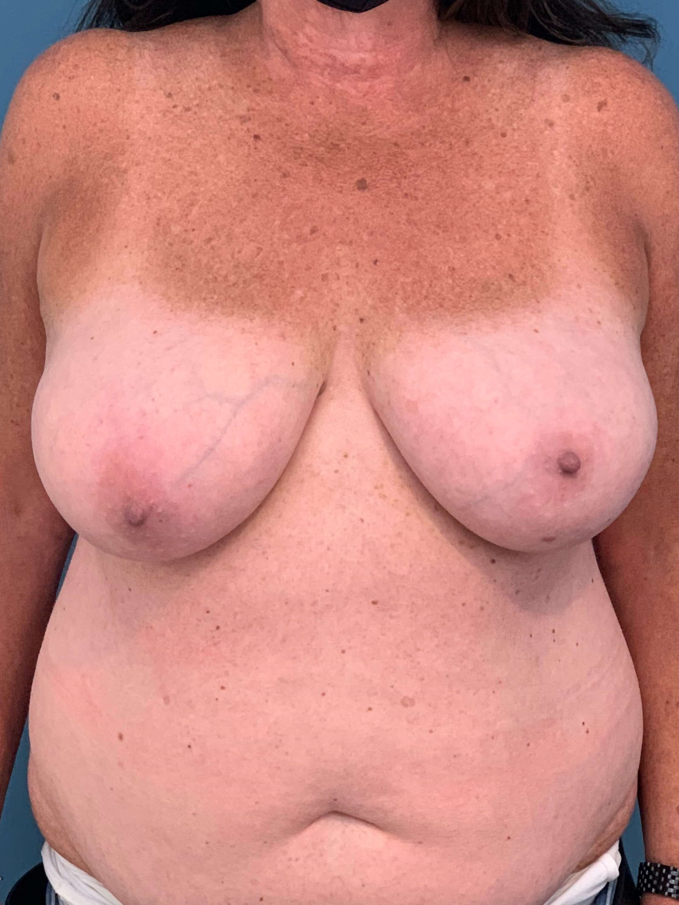 Bilateral Reduction Mammaplasty and Liposuction of Back — before, view 1