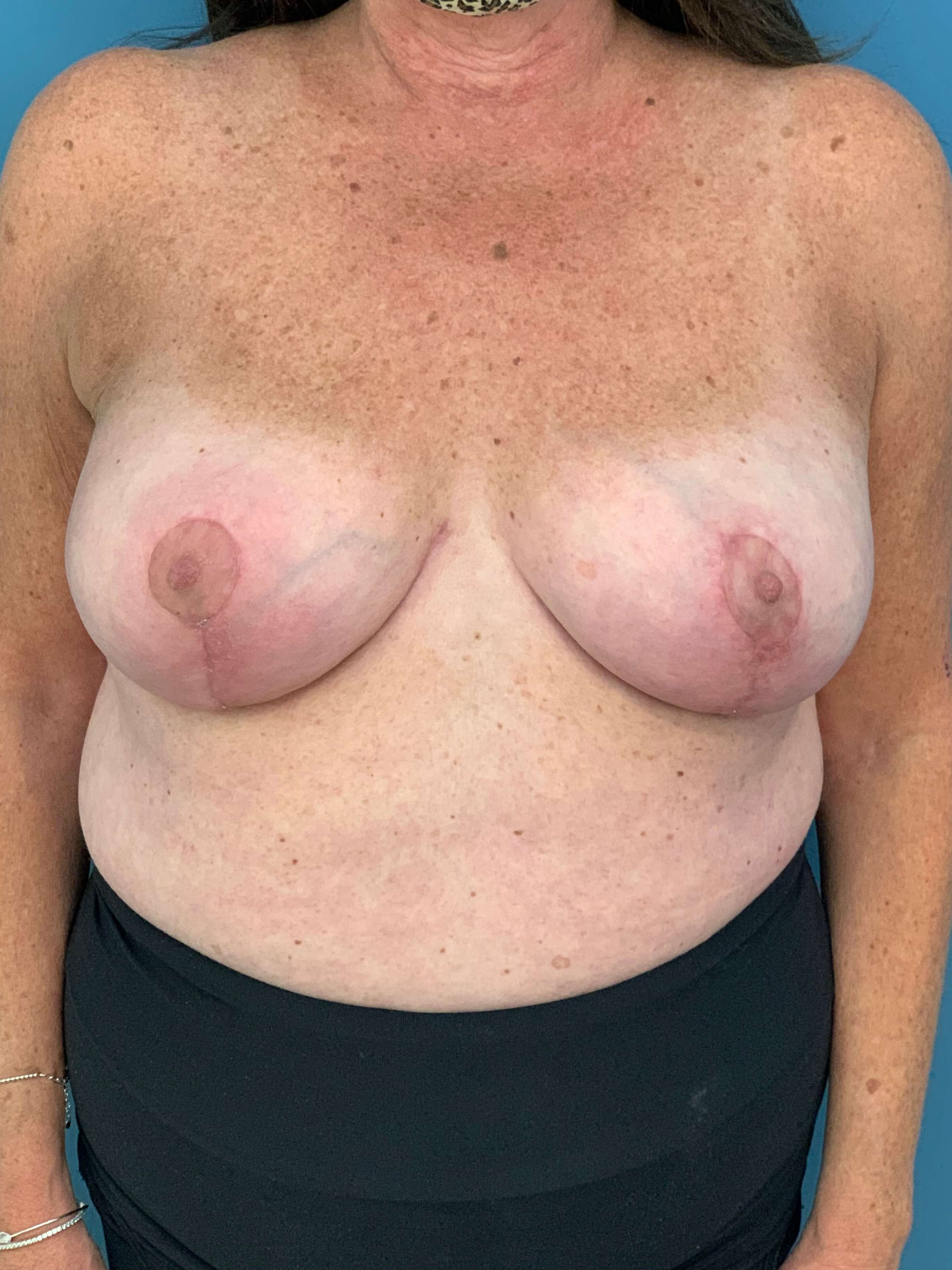 Bilateral Reduction Mammaplasty and Liposuction of Back