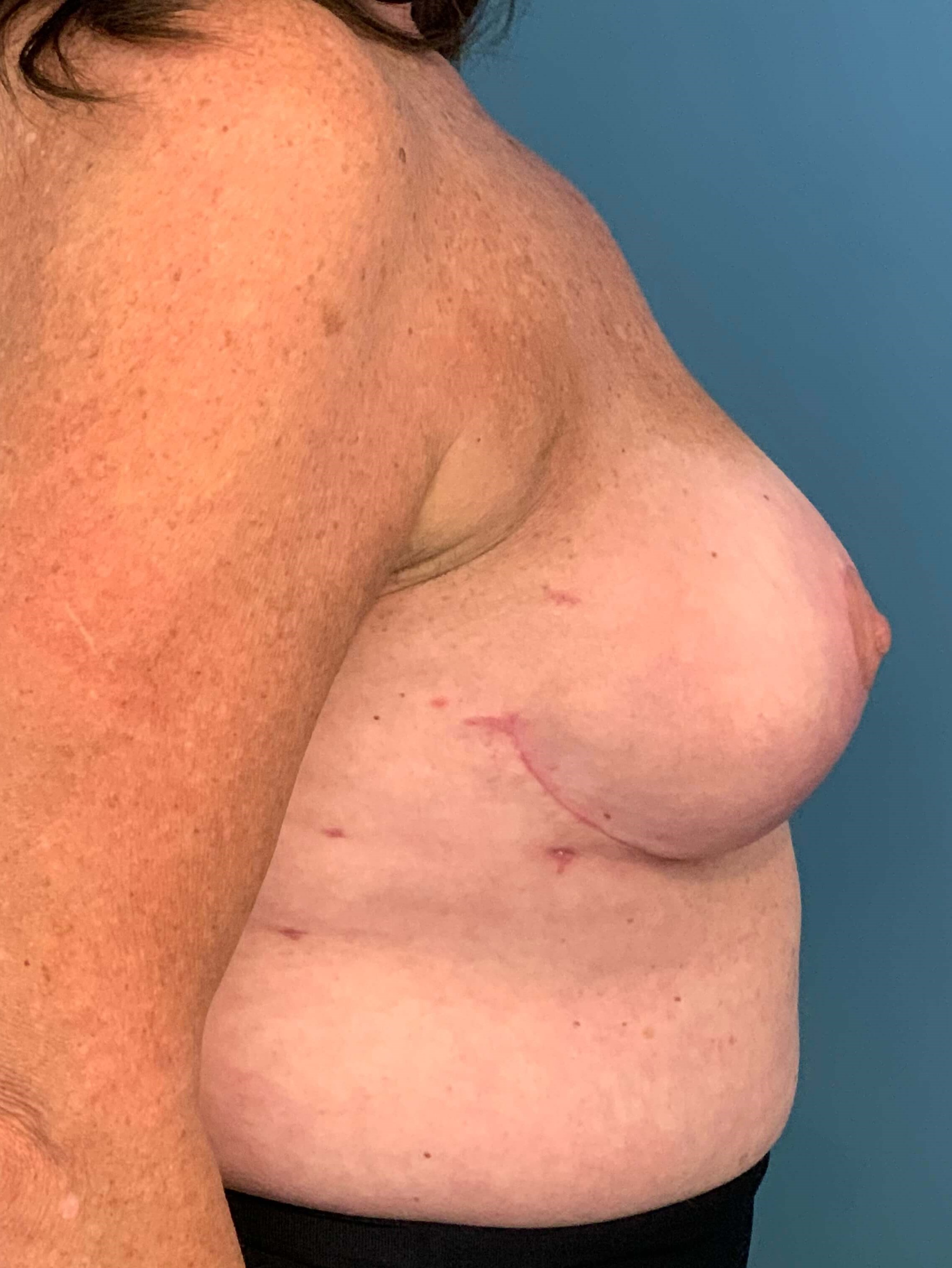 Bilateral Reduction Mammaplasty and Liposuction of Back — after, view 2