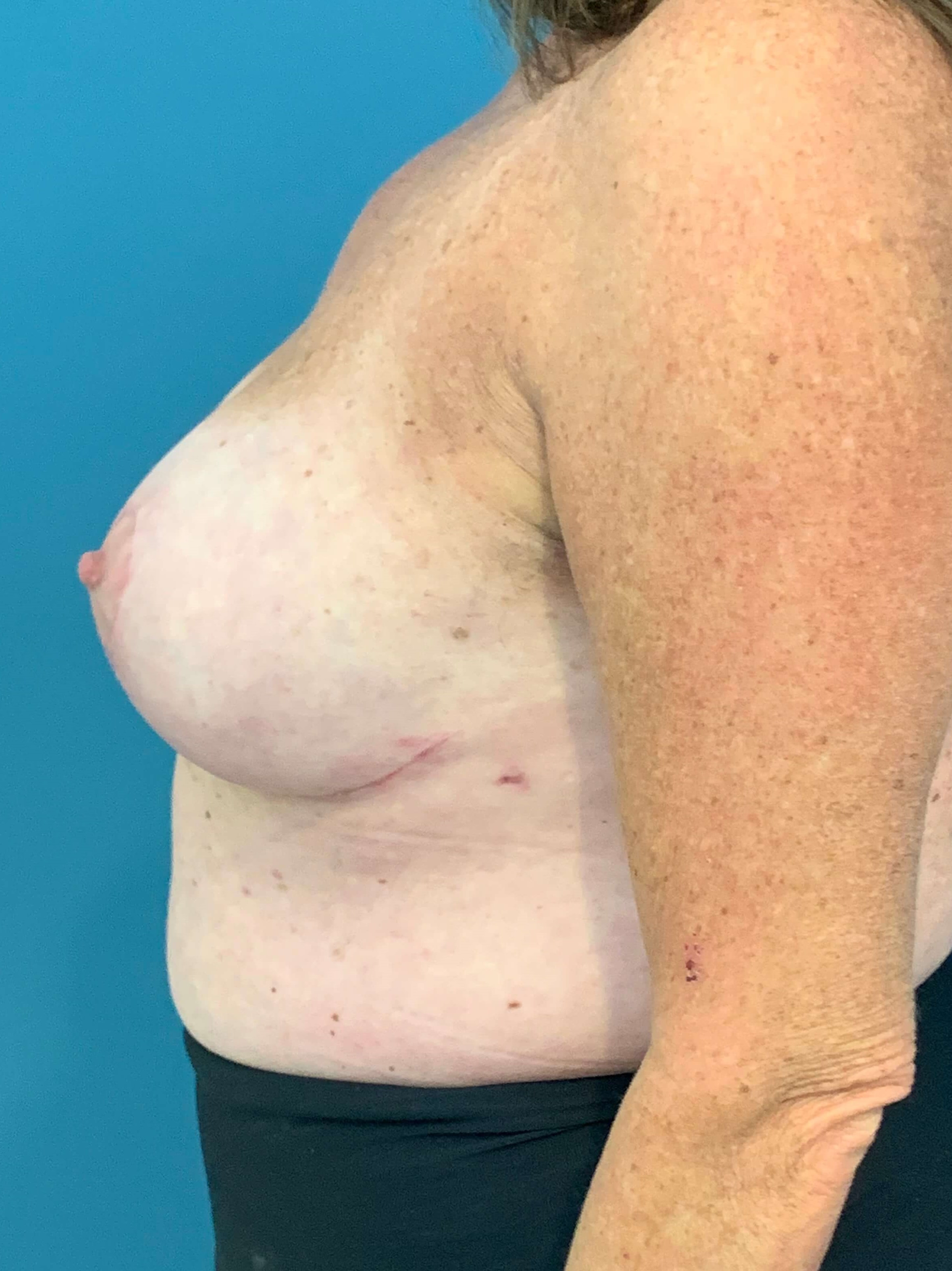 Bilateral Reduction Mammaplasty and Liposuction of Back — after, view 3