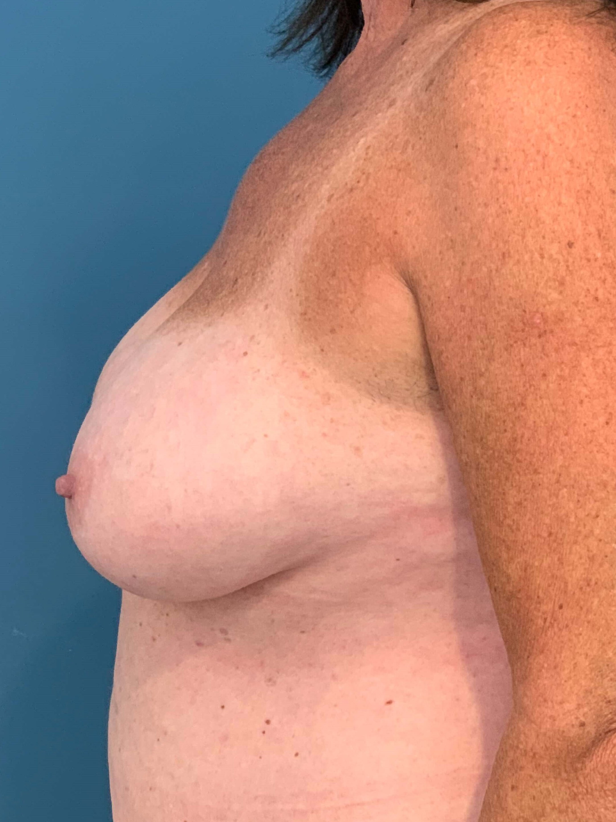 Bilateral Reduction Mammaplasty and Liposuction of Back — before, view 3
