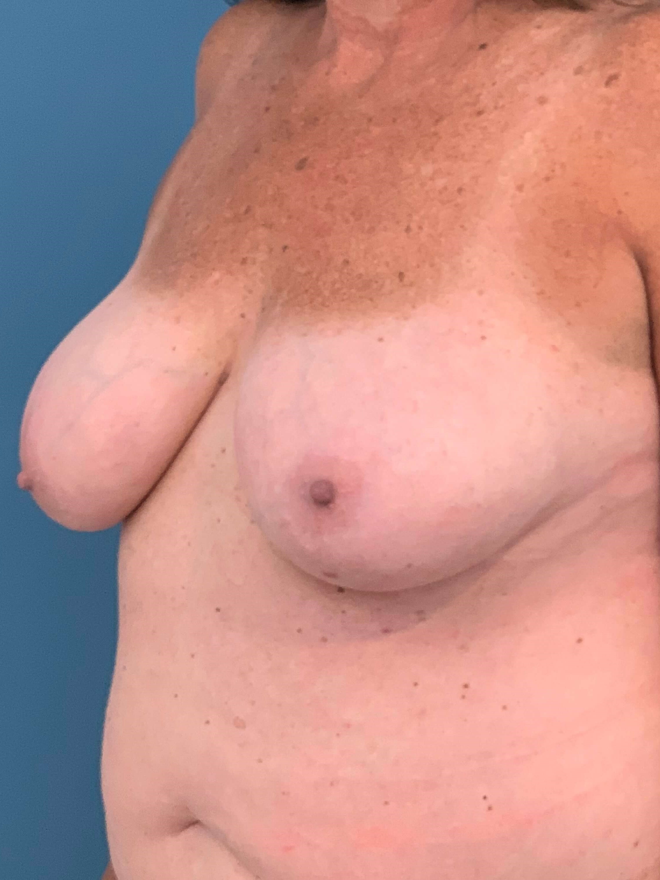 Bilateral Reduction Mammaplasty and Liposuction of Back — before, view 4