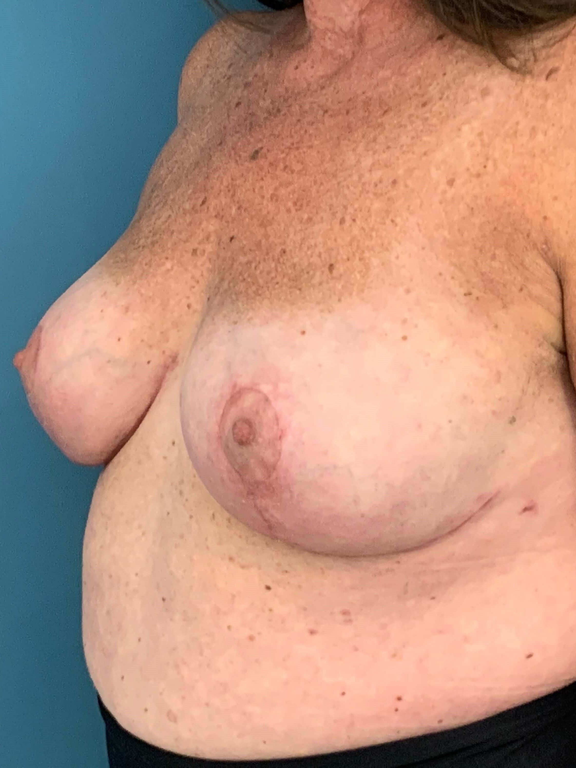 Bilateral Reduction Mammaplasty and Liposuction of Back — after, view 4