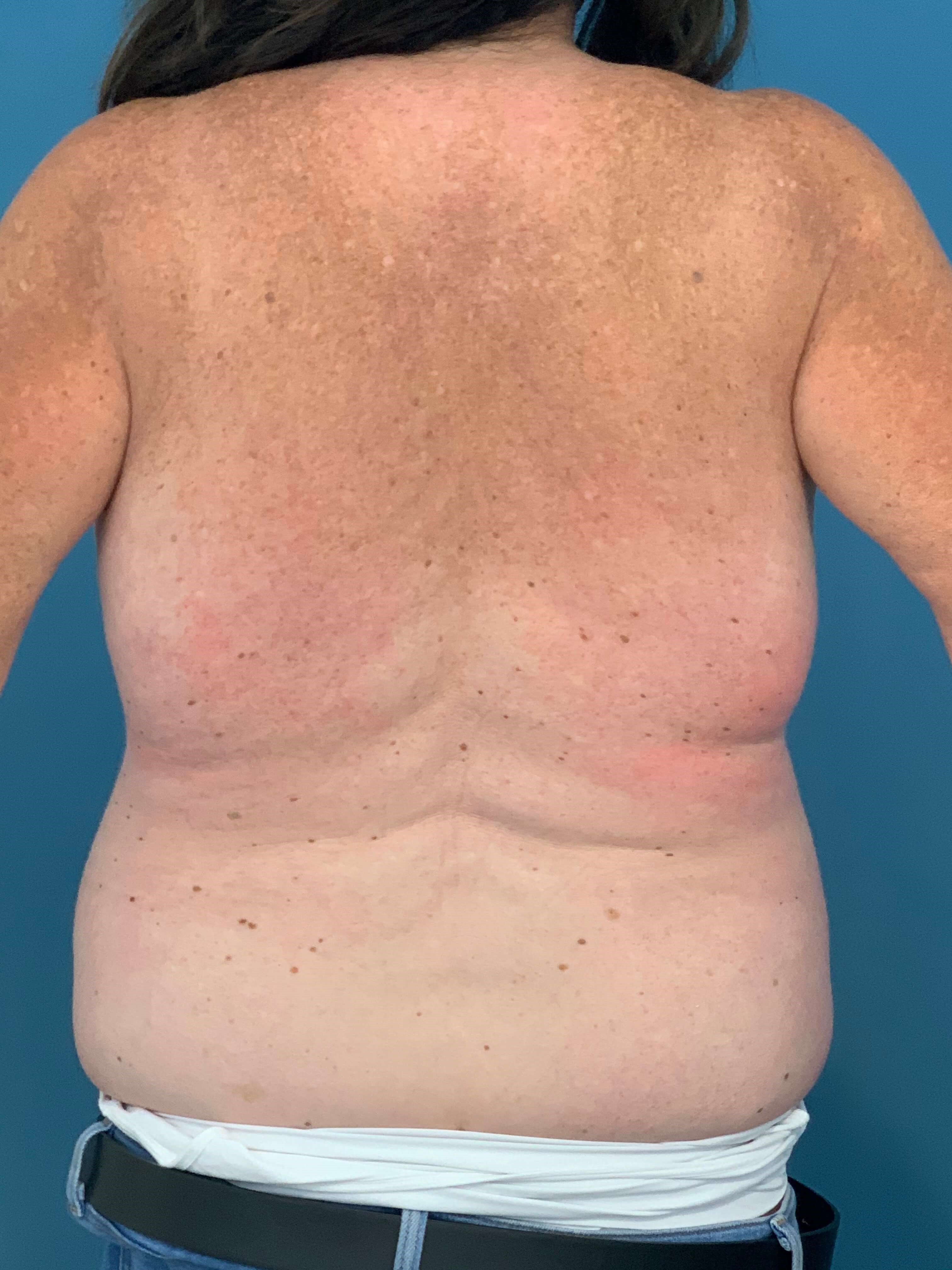 Bilateral Reduction Mammaplasty and Liposuction of Back — before, view 6