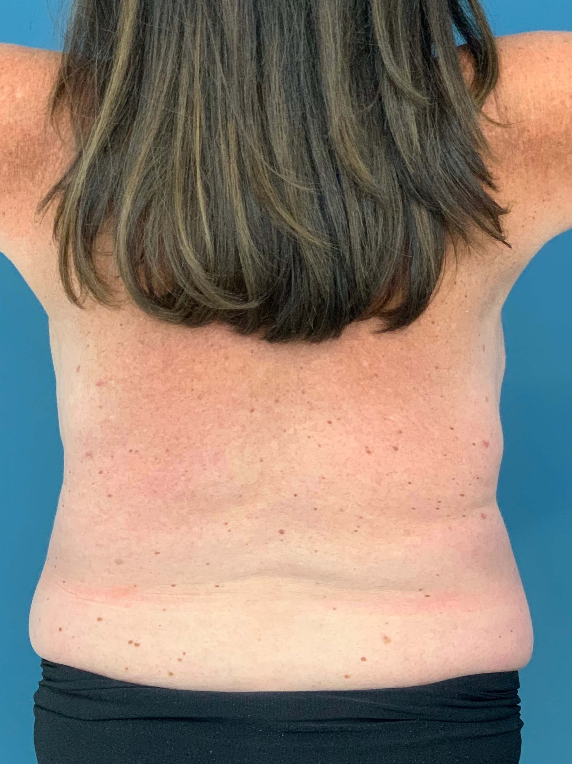 Bilateral Reduction Mammaplasty and Liposuction of Back — after, view 6