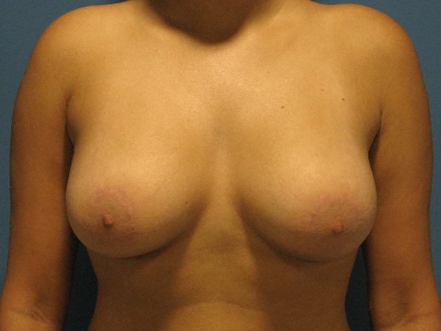 Breast Aug and Lift in Tuberous Breast Patient