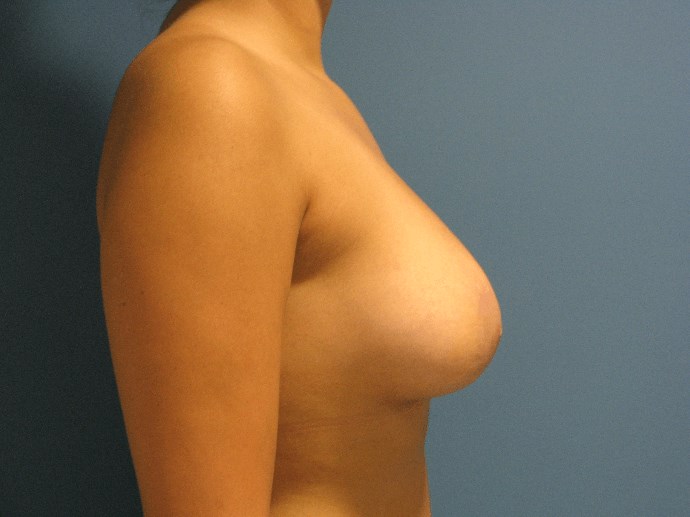 Breast Aug and Lift in Tuberous Breast Patient — after, view 2