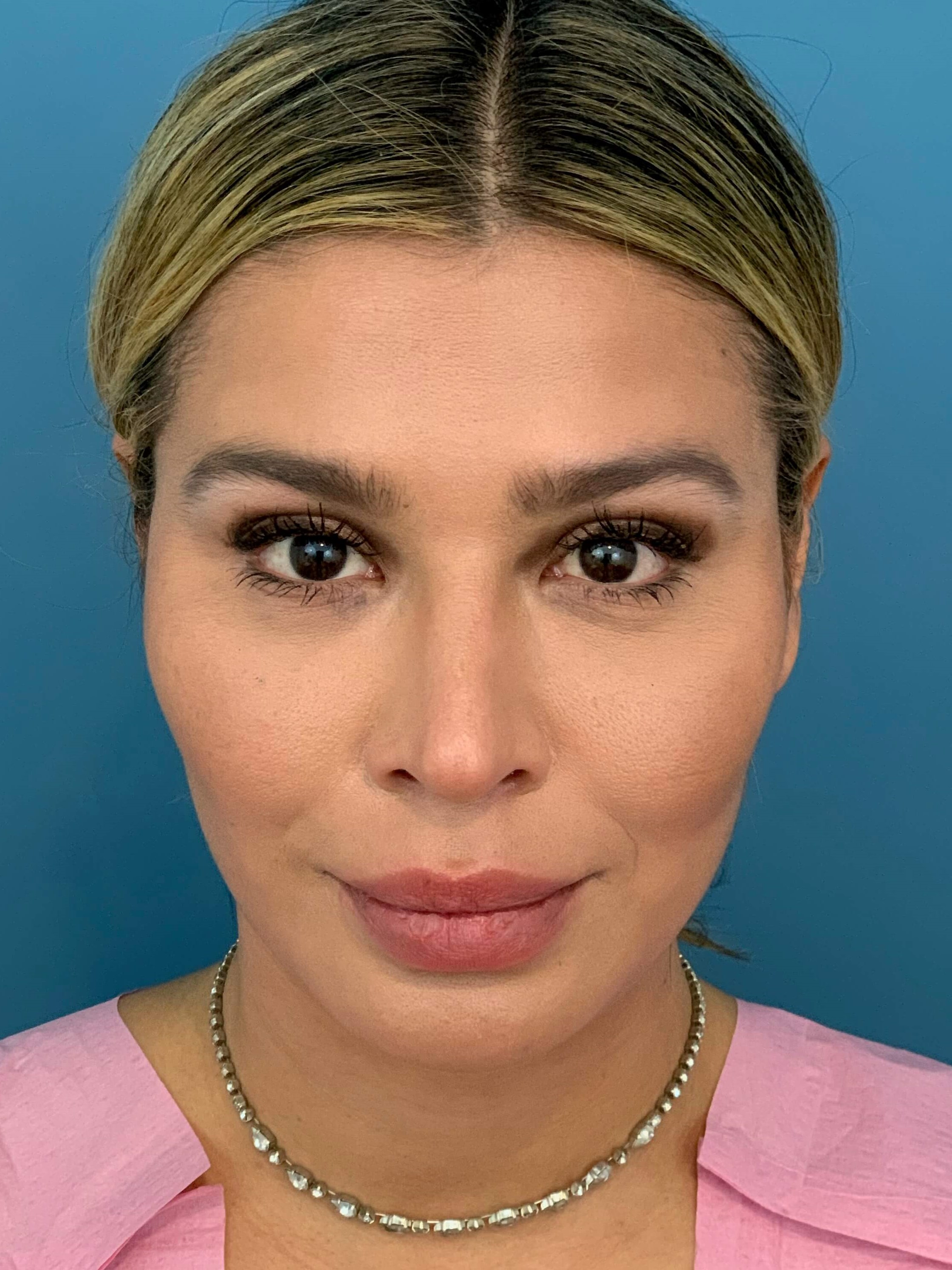 Buccal Fat Removal — before, view 2