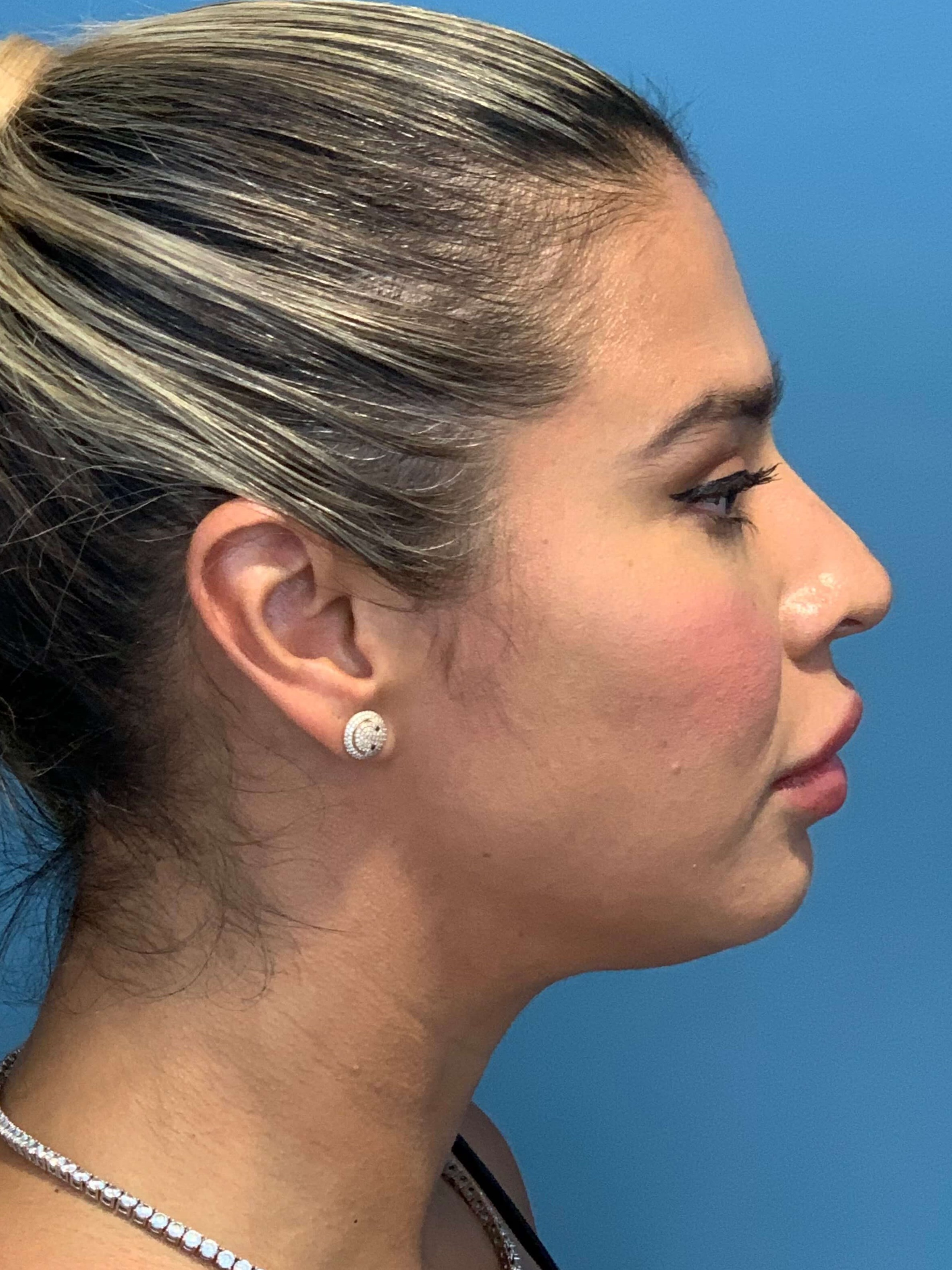Buccal Fat Removal — before, view 3