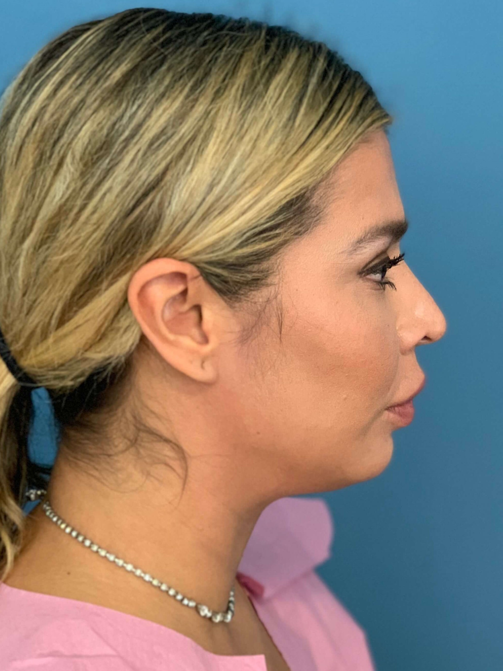 Buccal Fat Removal — before, view 4