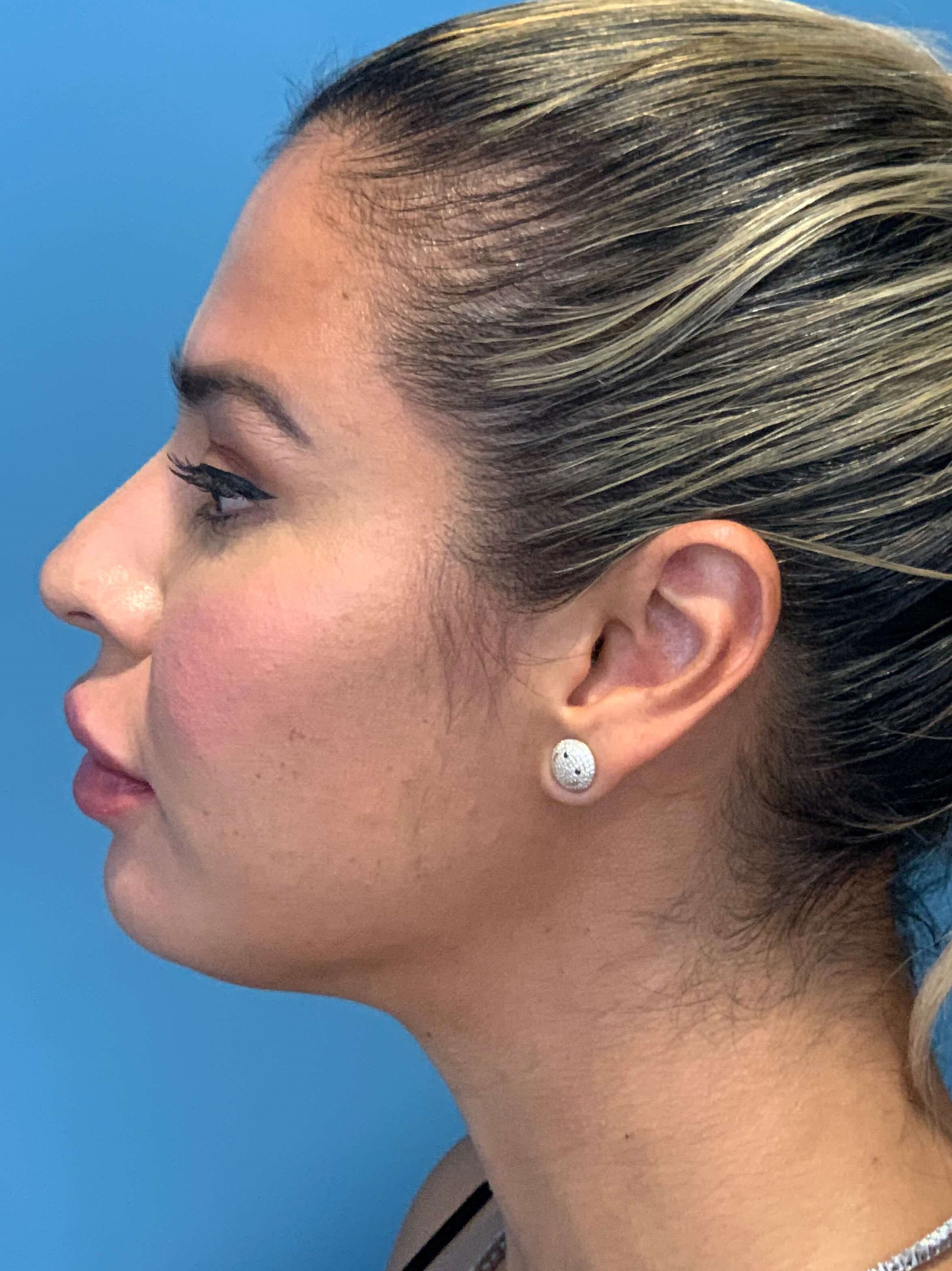 Buccal Fat Removal — before, view 5