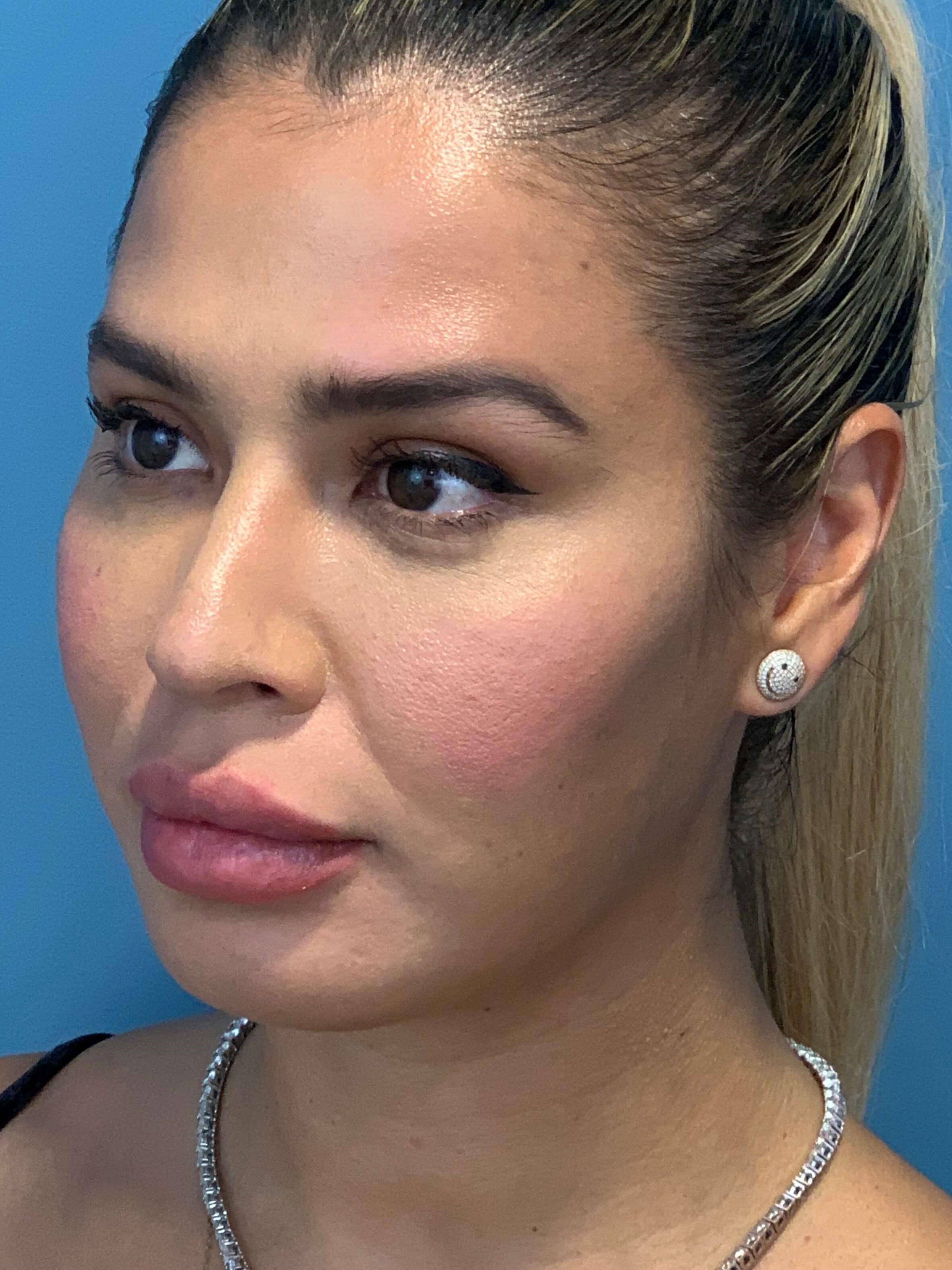 Buccal Fat Removal — after, view 2