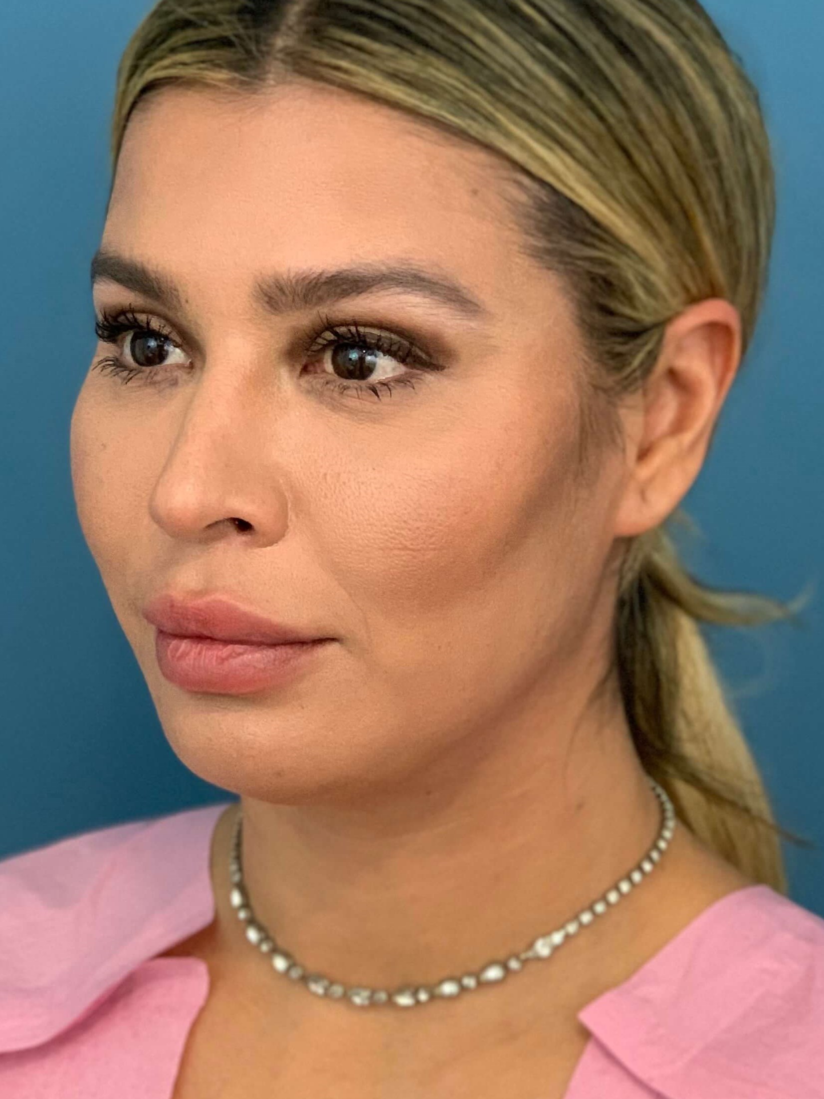 Buccal Fat Removal — after, view 3