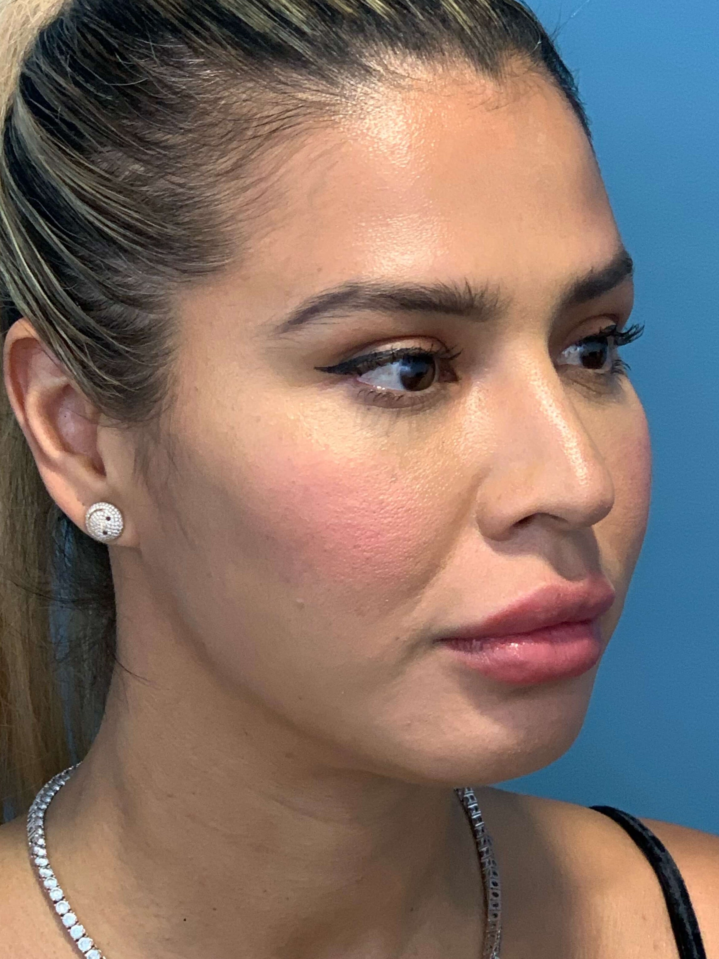 Buccal Fat Removal — after, view 4