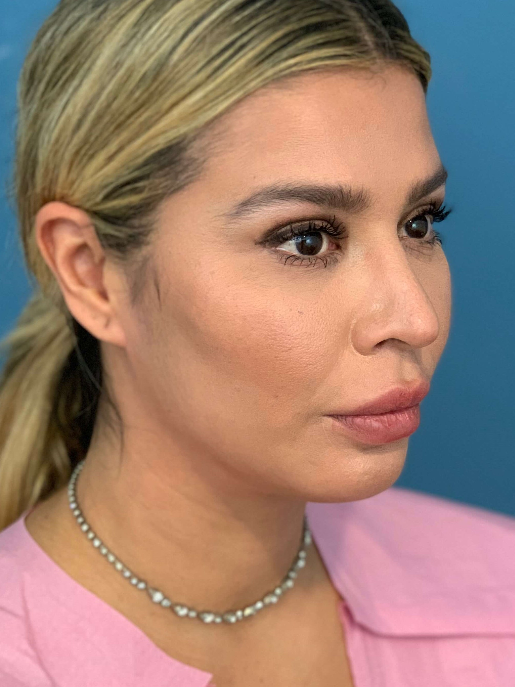 Buccal Fat Removal — after, view 5