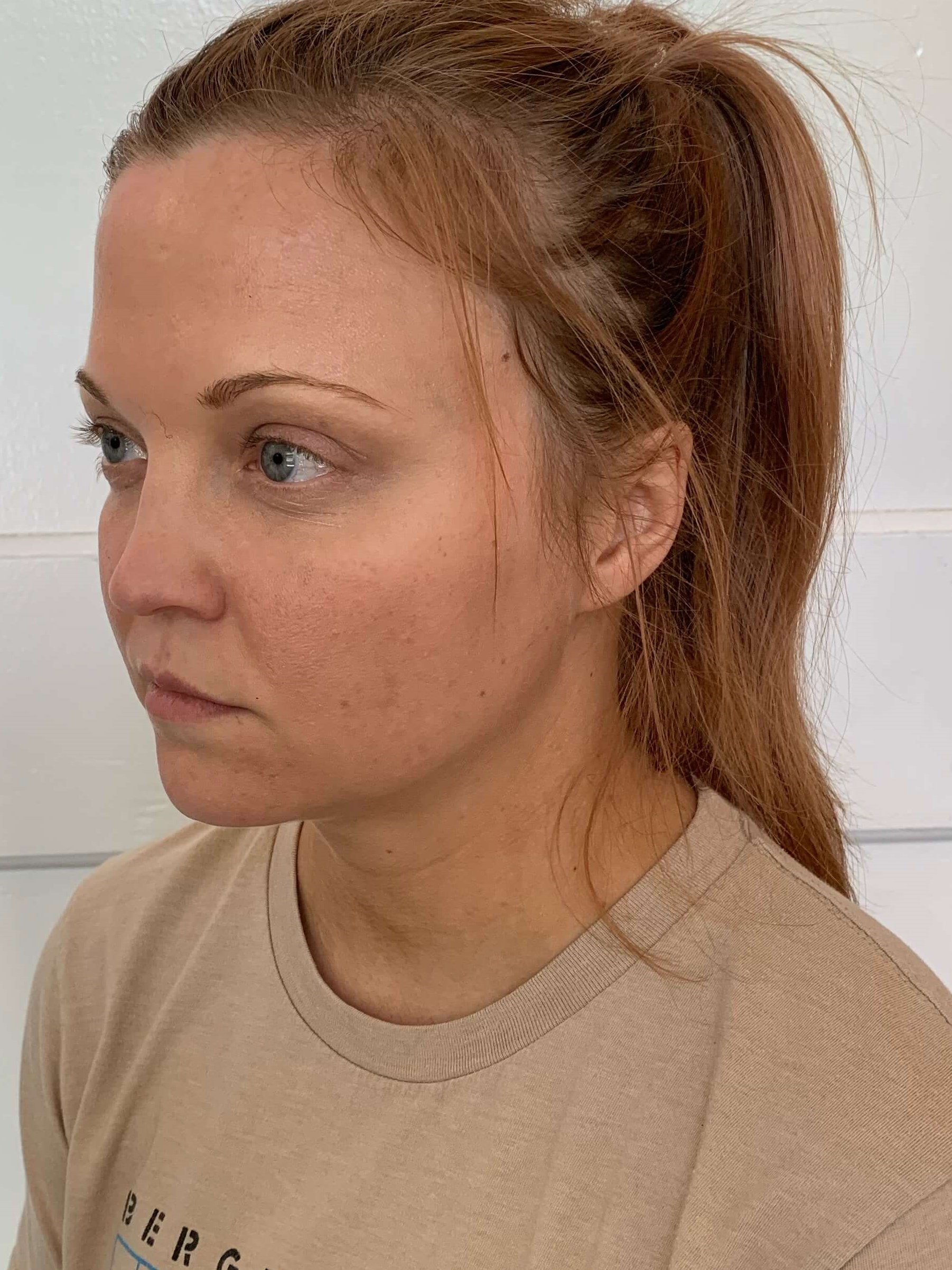 Zoom Neck Slim Procedure — before, view 2