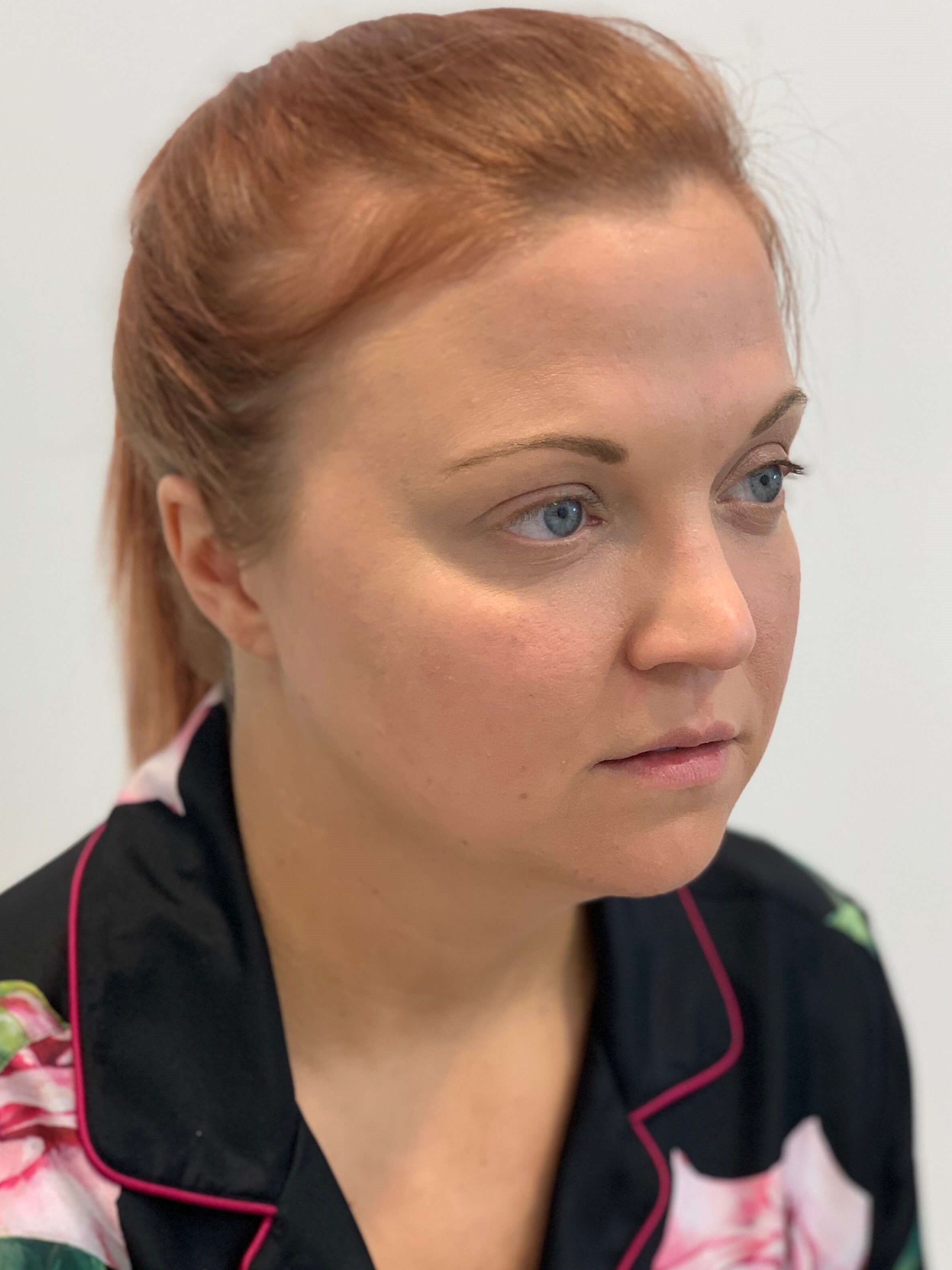 Zoom Neck Slim Procedure