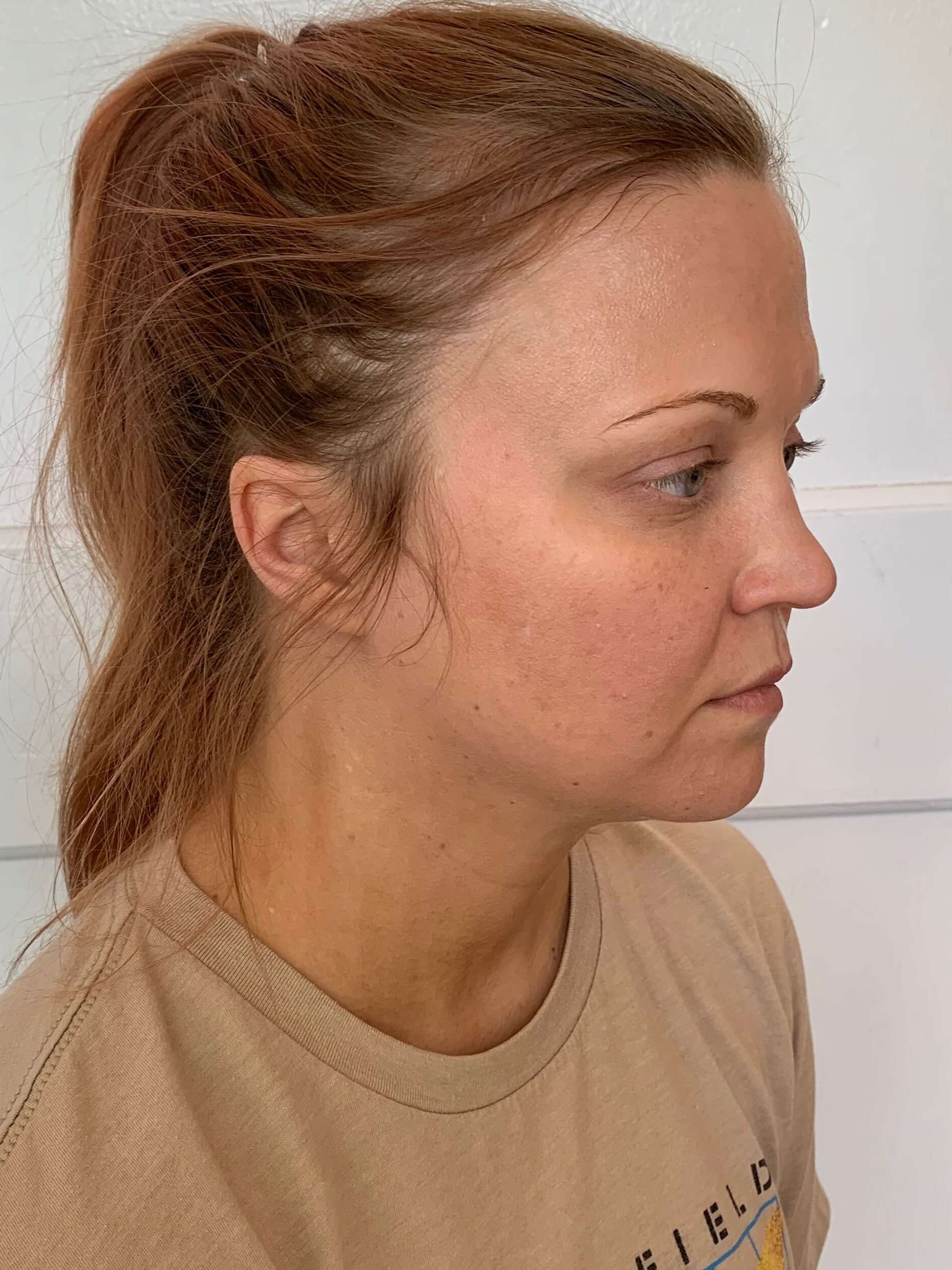 Zoom Neck Slim Procedure — after, view 2