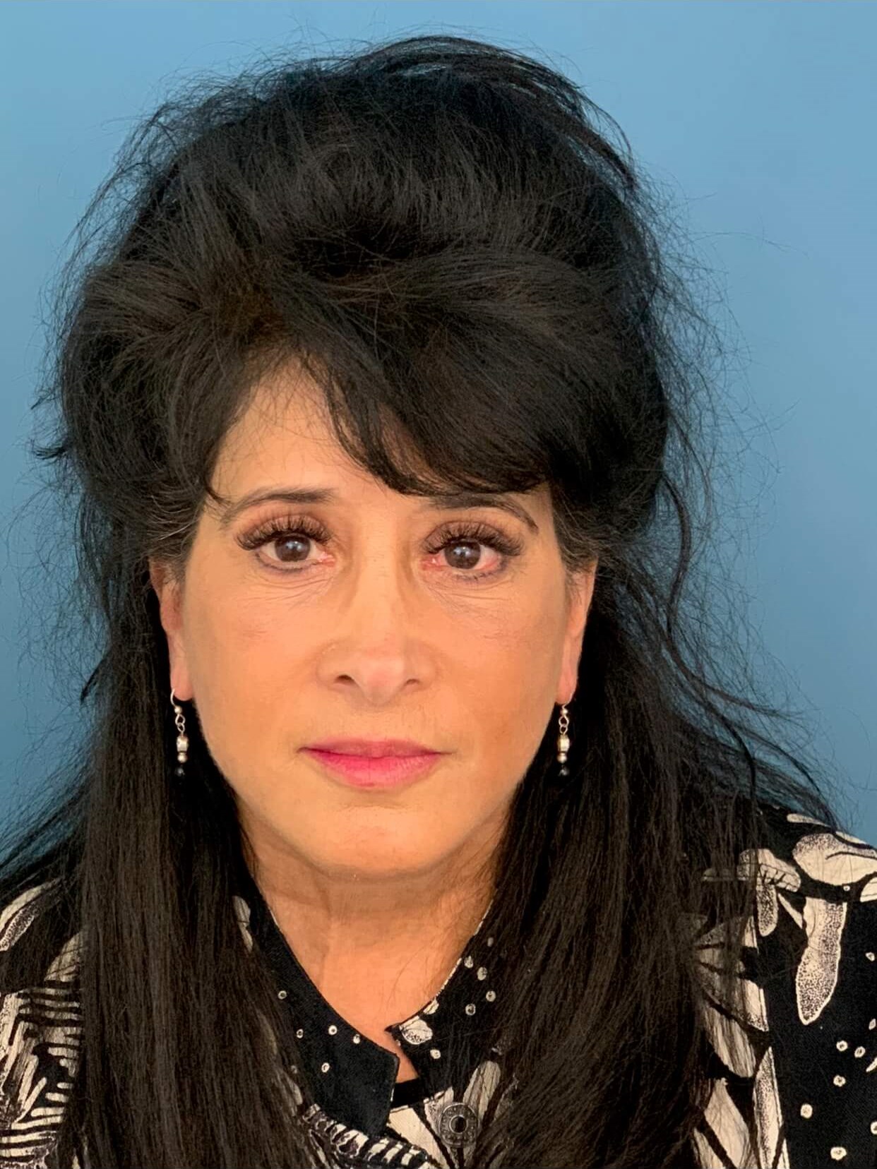 Facelift, Temporal Brow Lift, and Lower Eyelid Fat Transposition