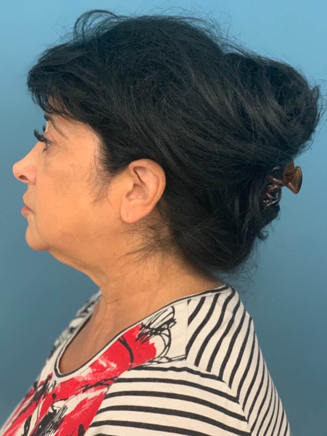 Facelift, Temporal Brow Lift, and Lower Eyelid Fat Transposition — before, view 2