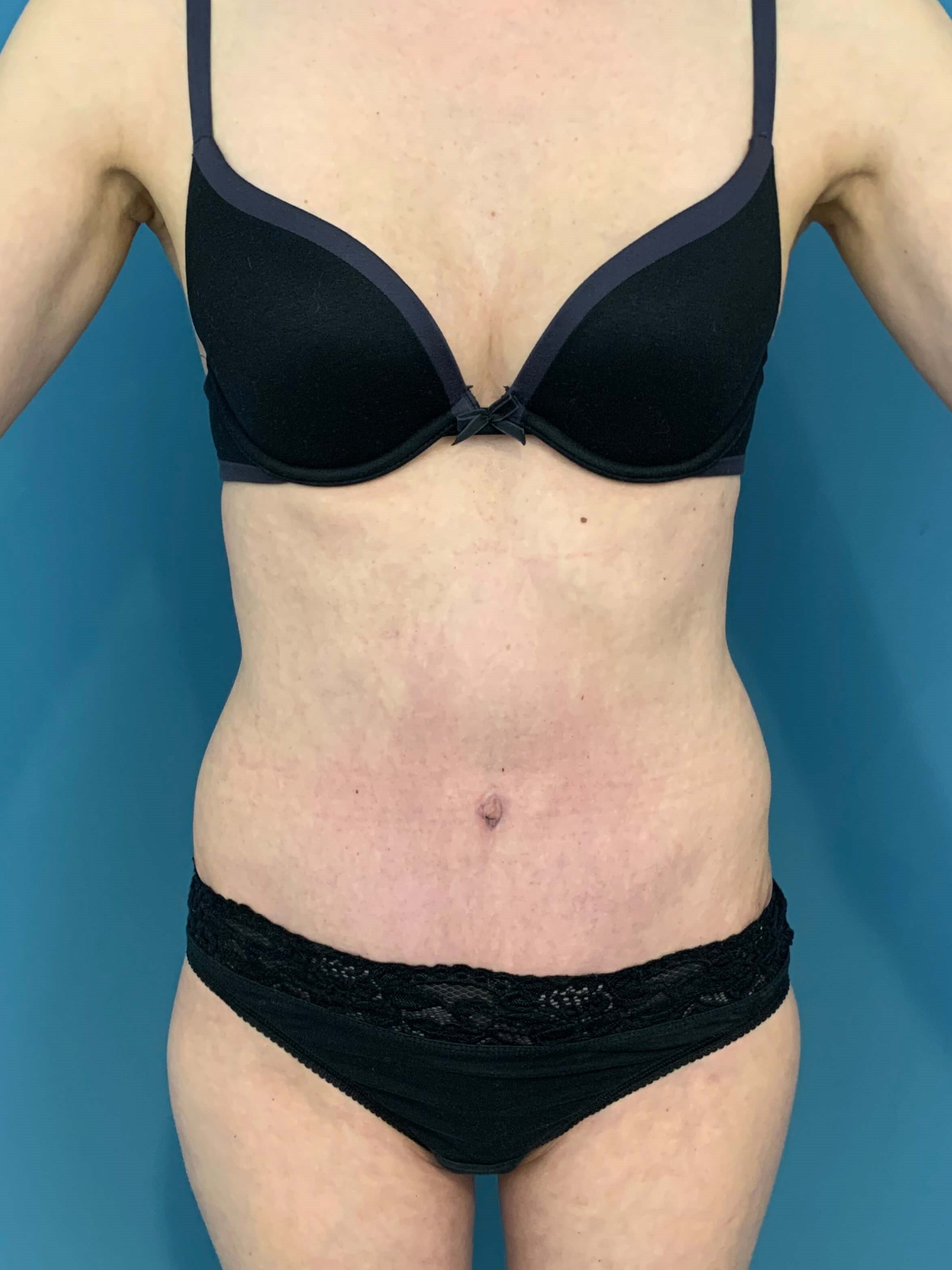 Abdominoplasty