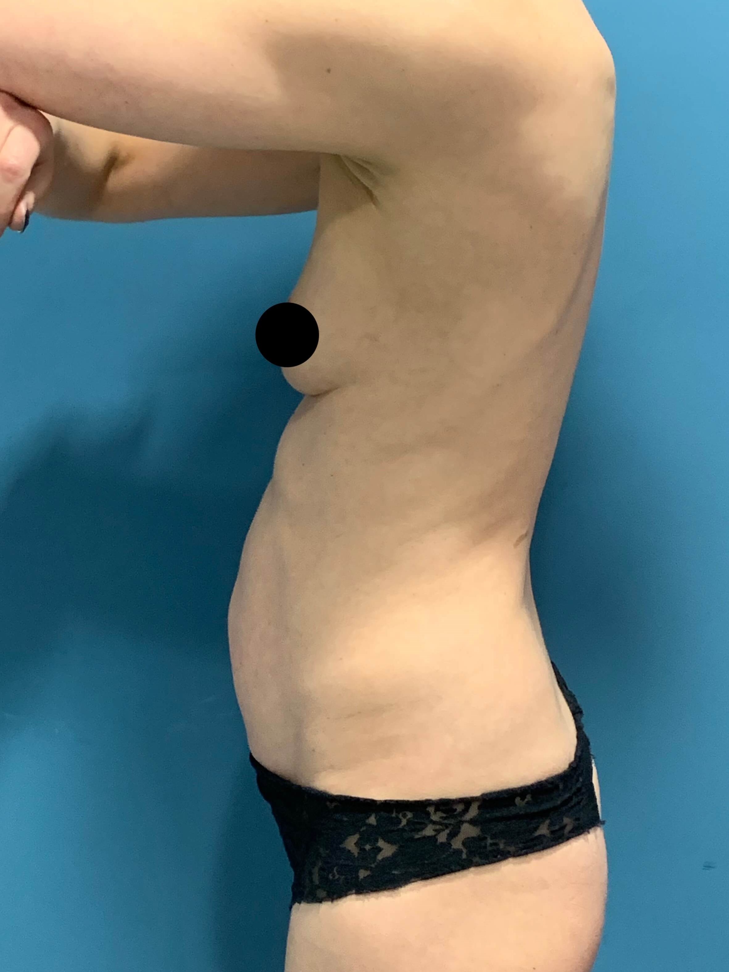 Abdominoplasty — before, view 2