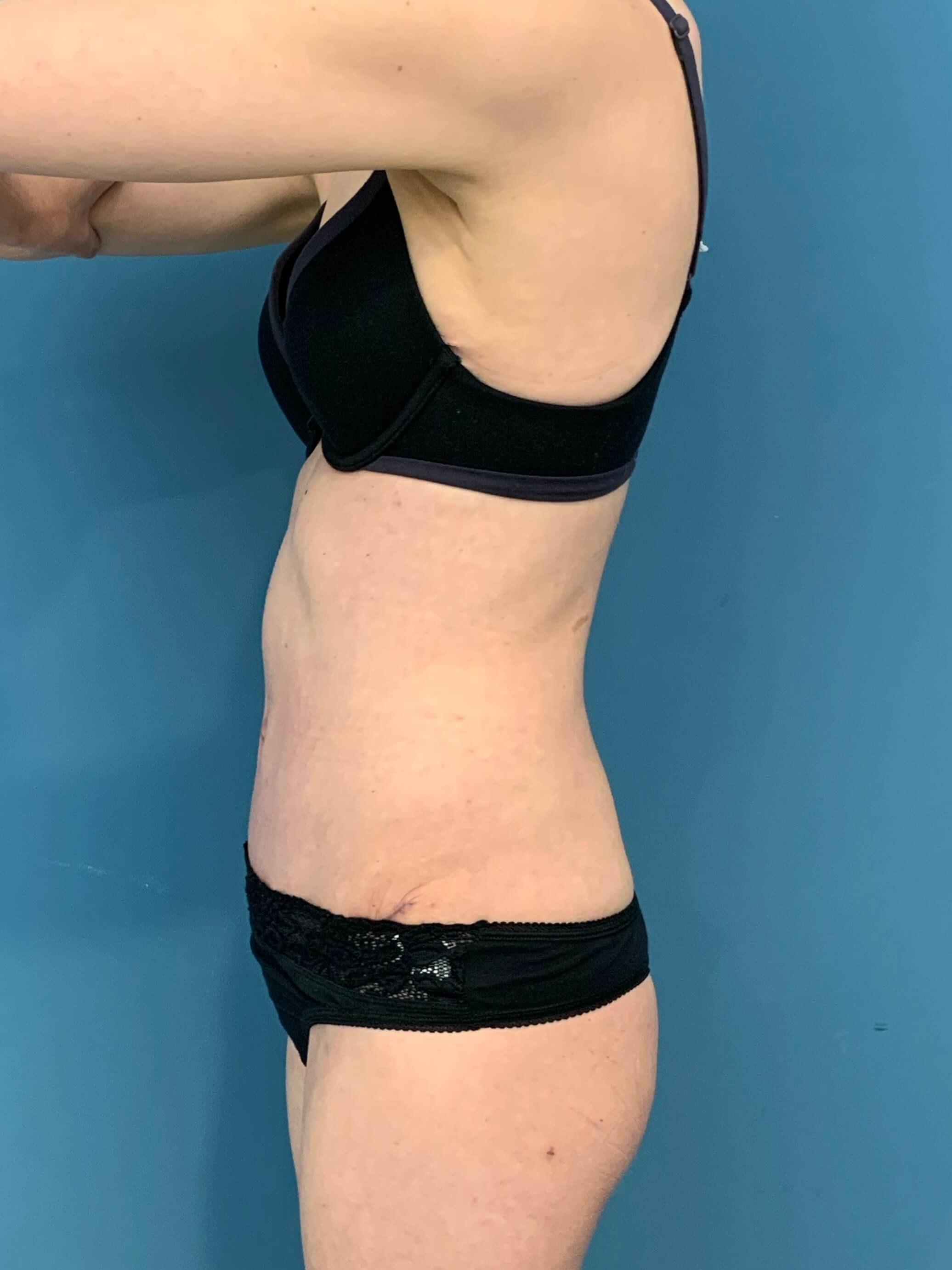 Abdominoplasty — after, view 2