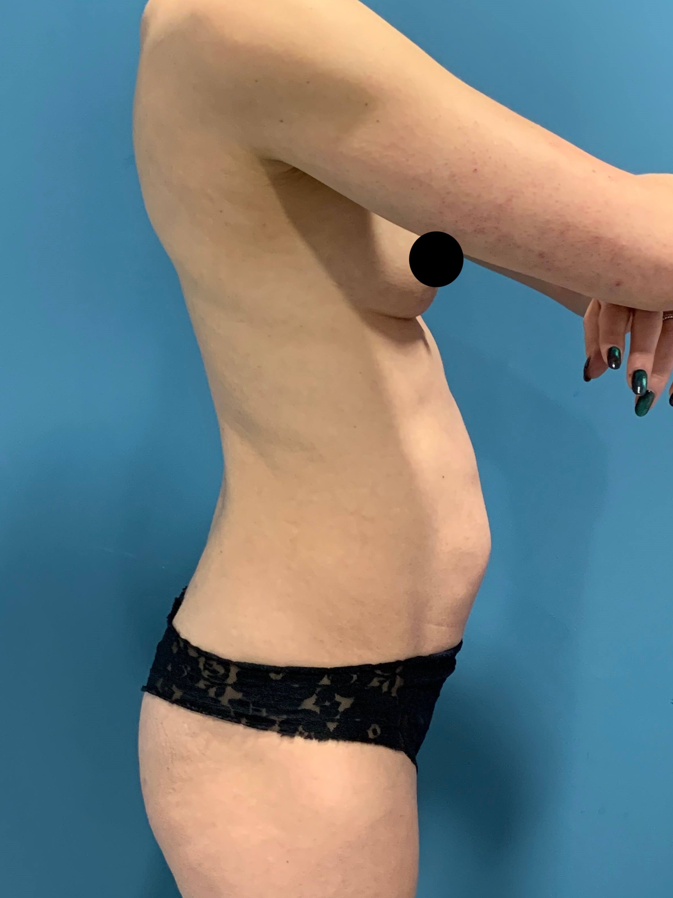 Abdominoplasty — before, view 3