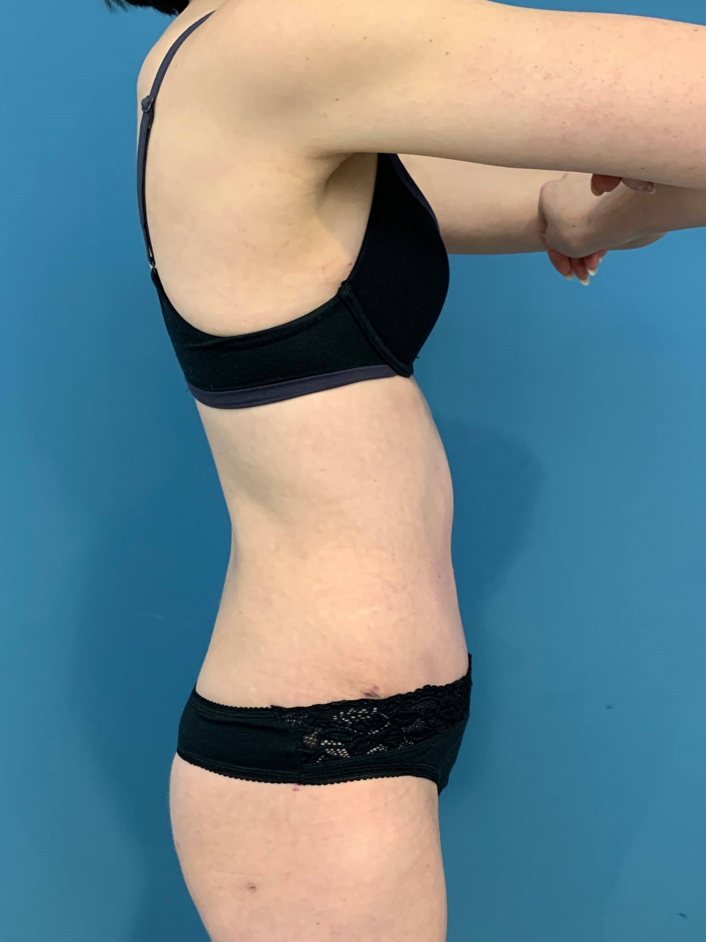Abdominoplasty — after, view 3