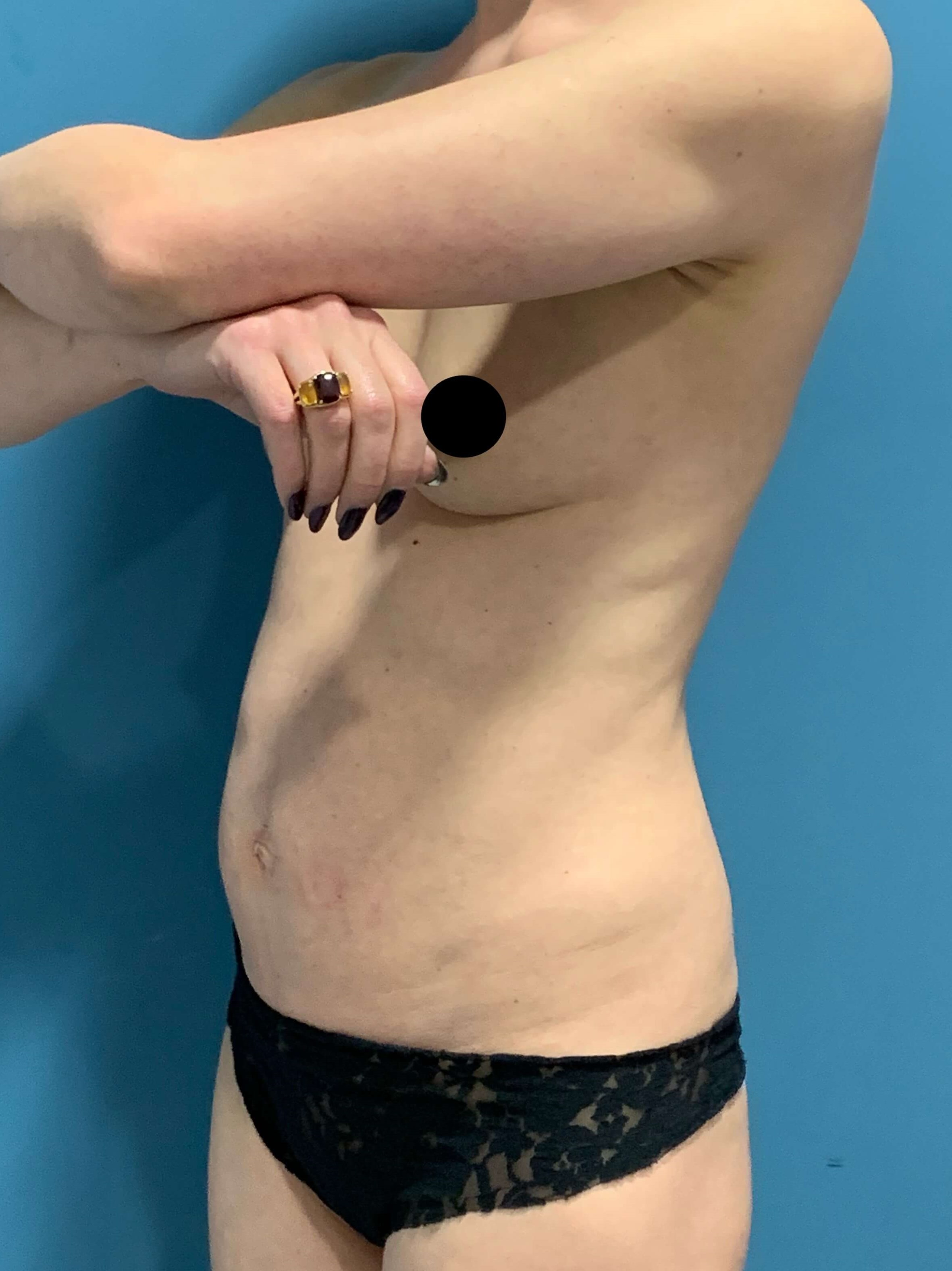 Abdominoplasty — before, view 4