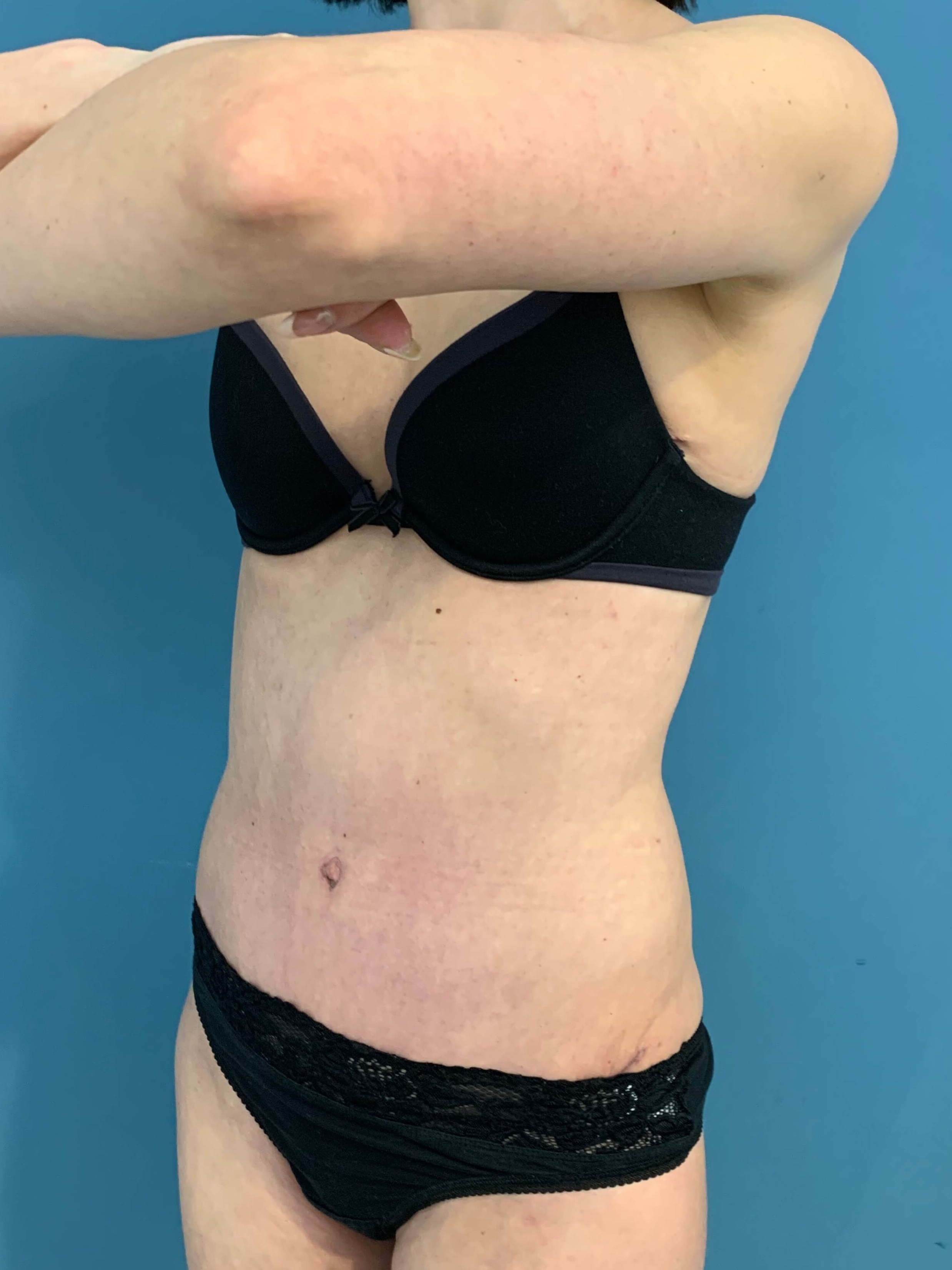 Abdominoplasty — after, view 4