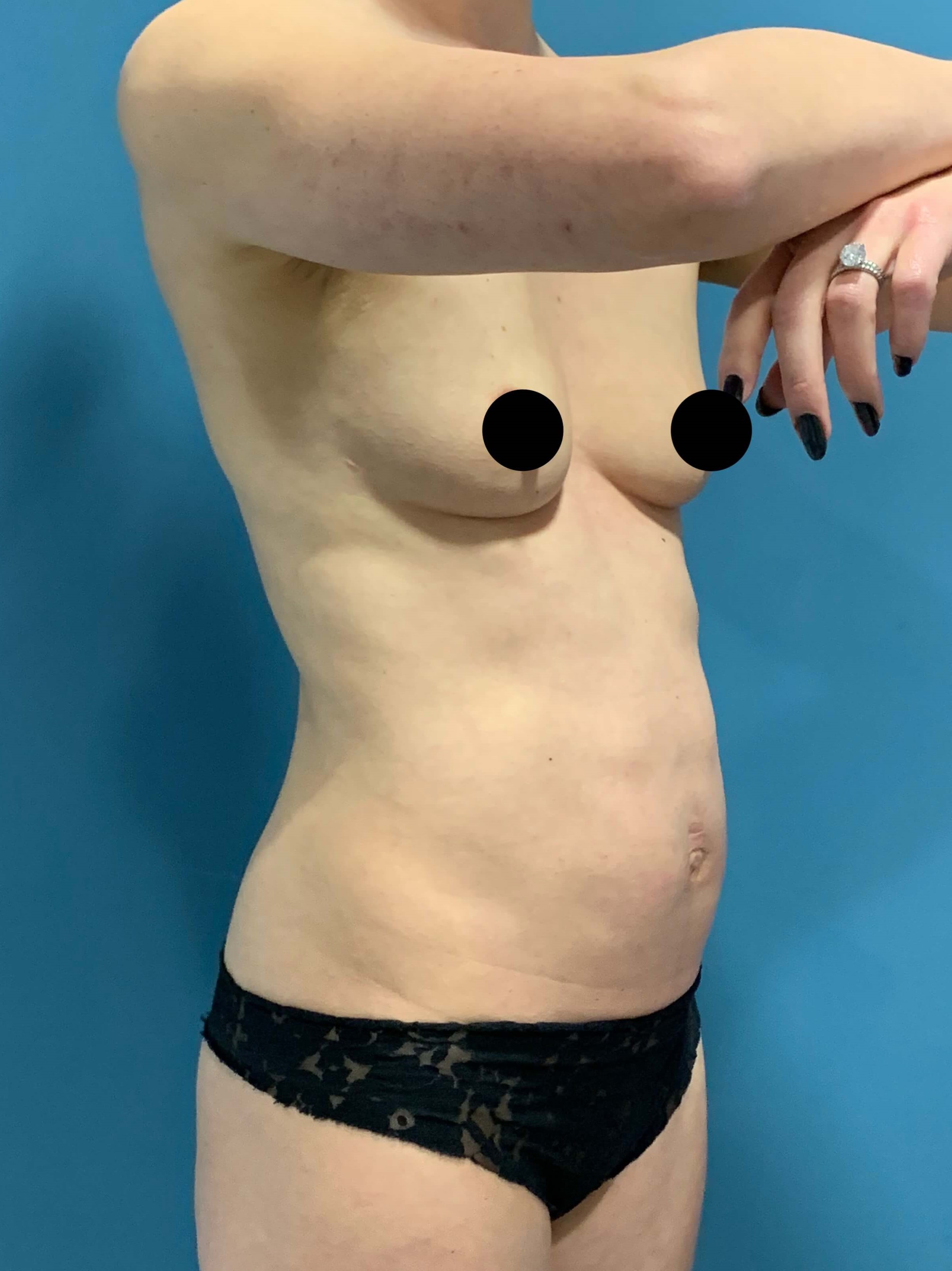 Abdominoplasty — before, view 5