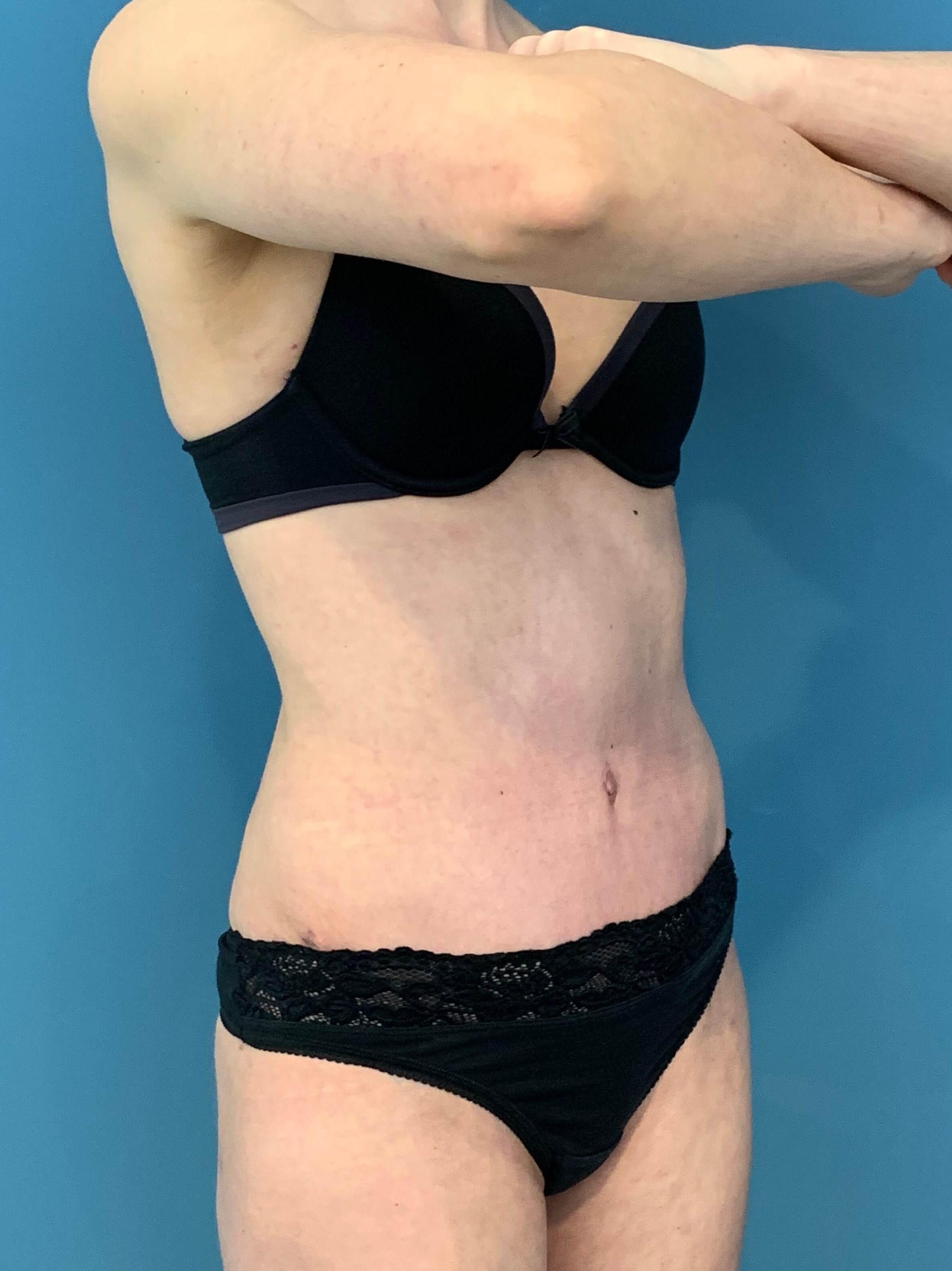 Abdominoplasty — after, view 5
