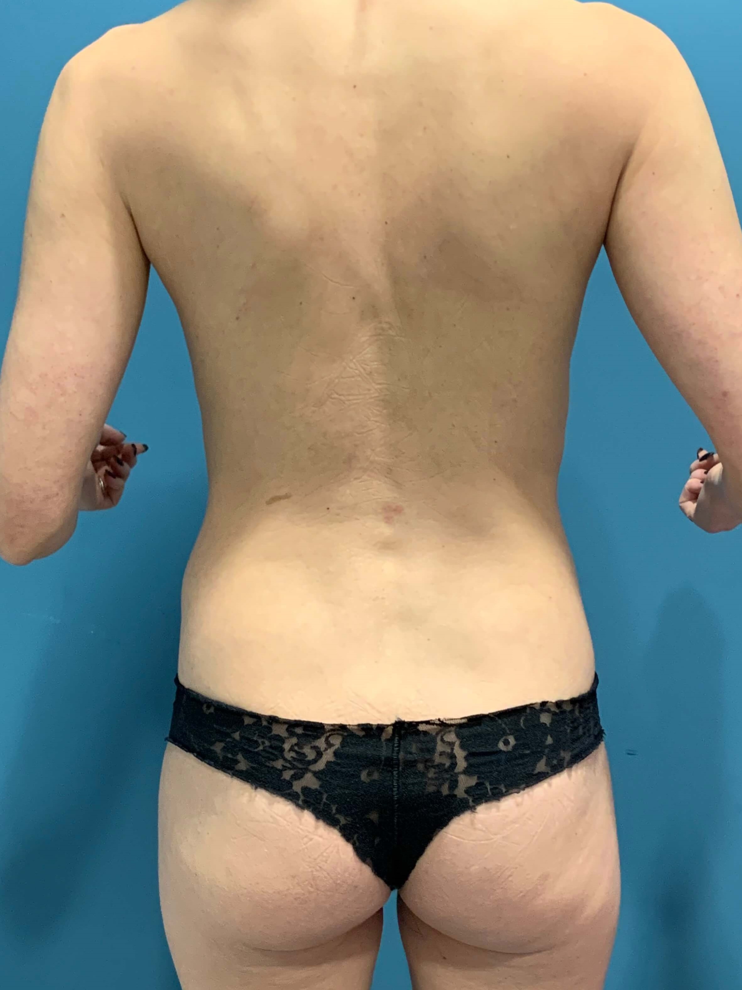 Abdominoplasty — before, view 6