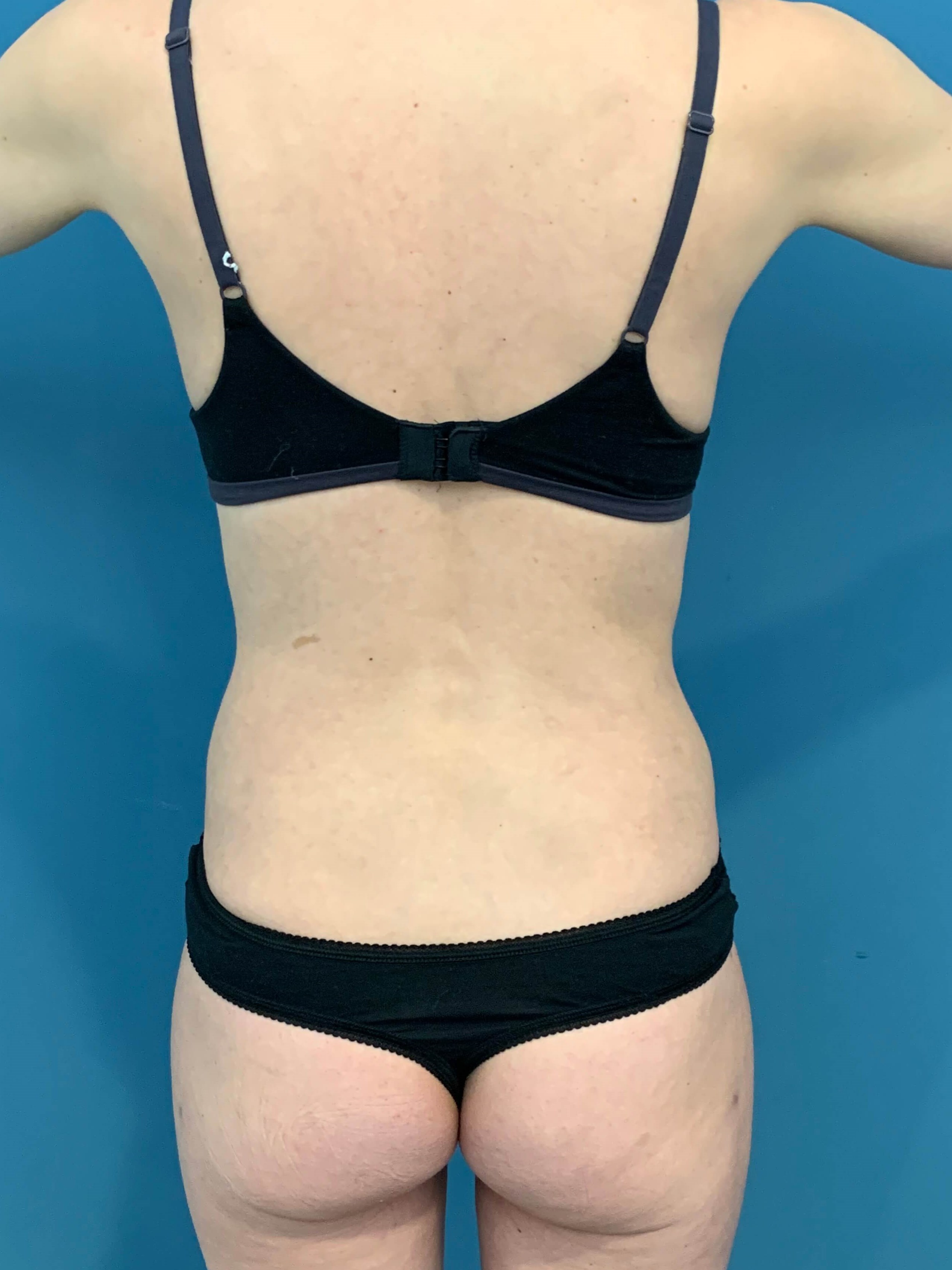Abdominoplasty — after, view 6