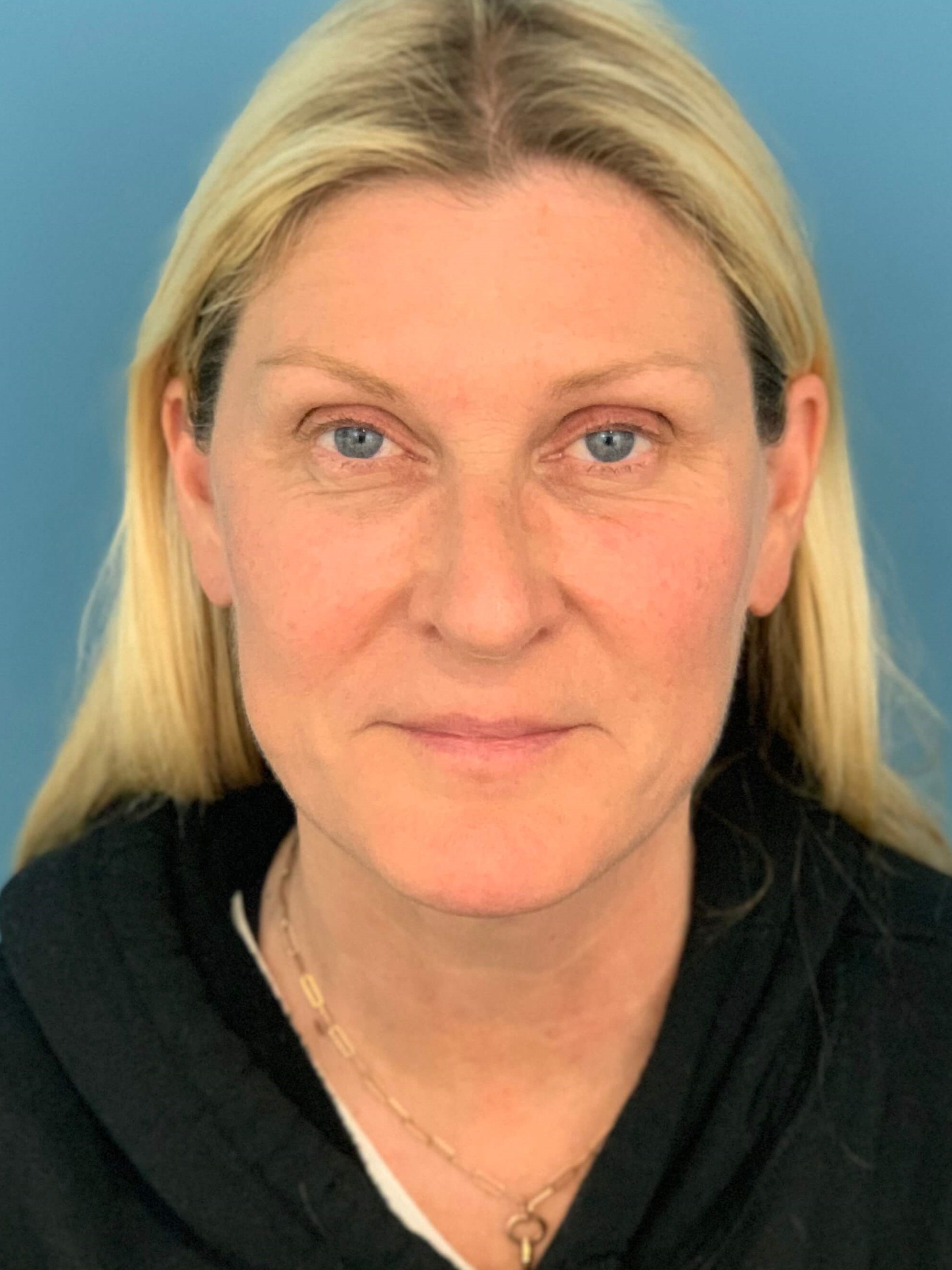 Secondary Lower Face and Neck Lift