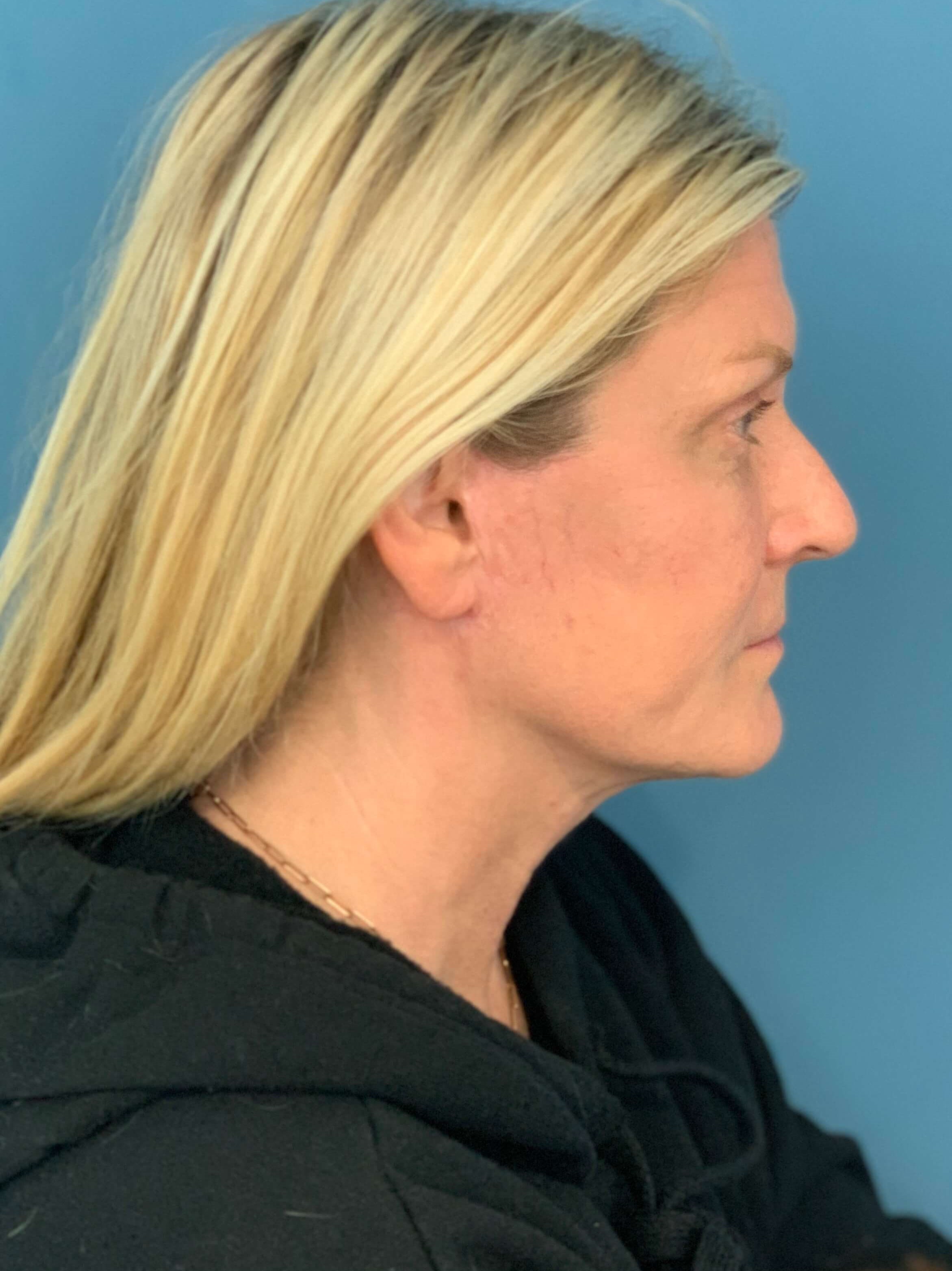 Secondary Lower Face and Neck Lift — after, view 2