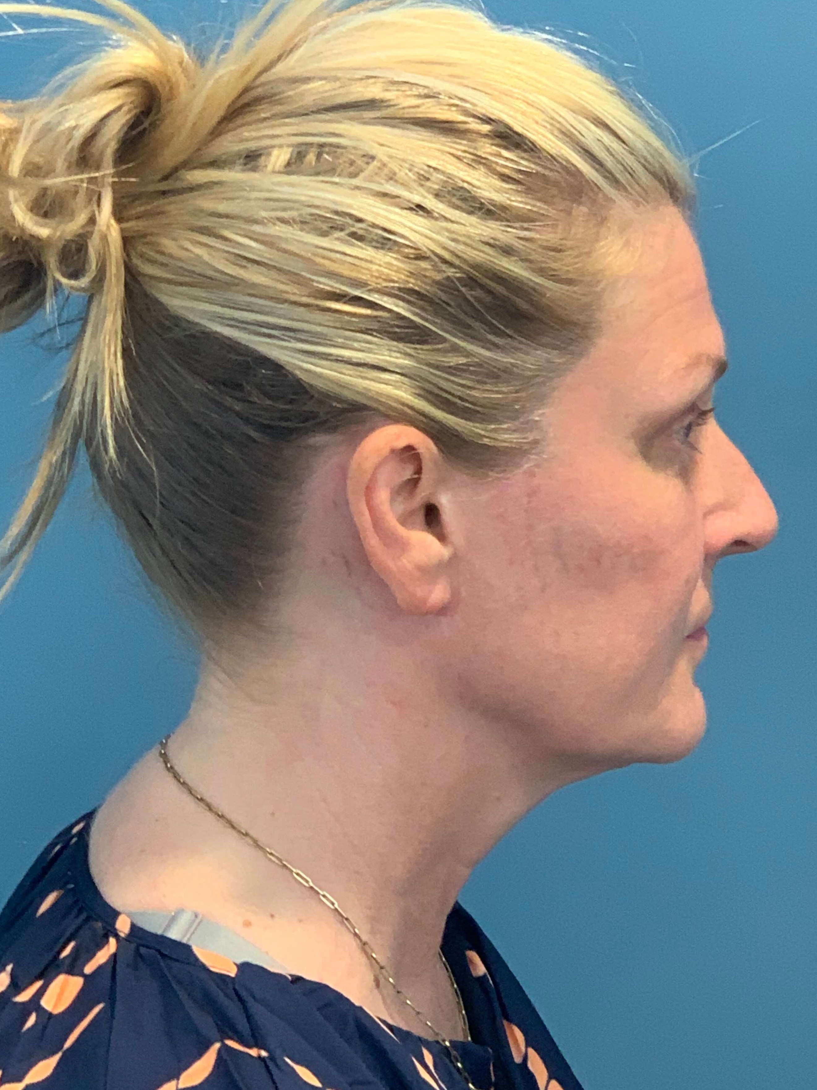 Secondary Lower Face and Neck Lift — before, view 2