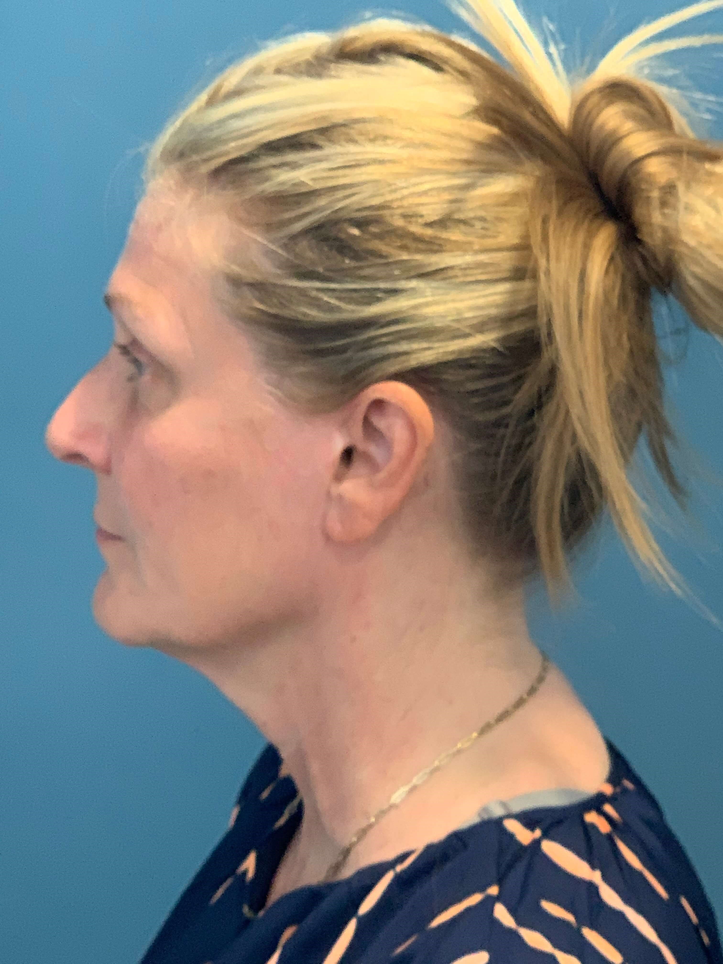 Secondary Lower Face and Neck Lift — before, view 3