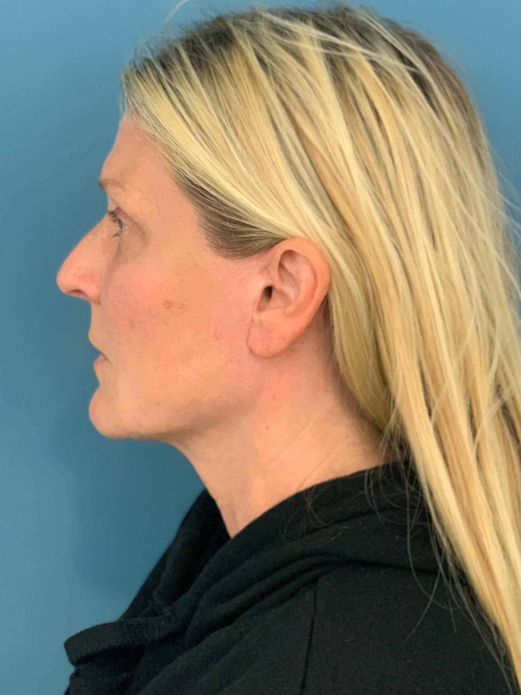 Secondary Lower Face and Neck Lift — after, view 3