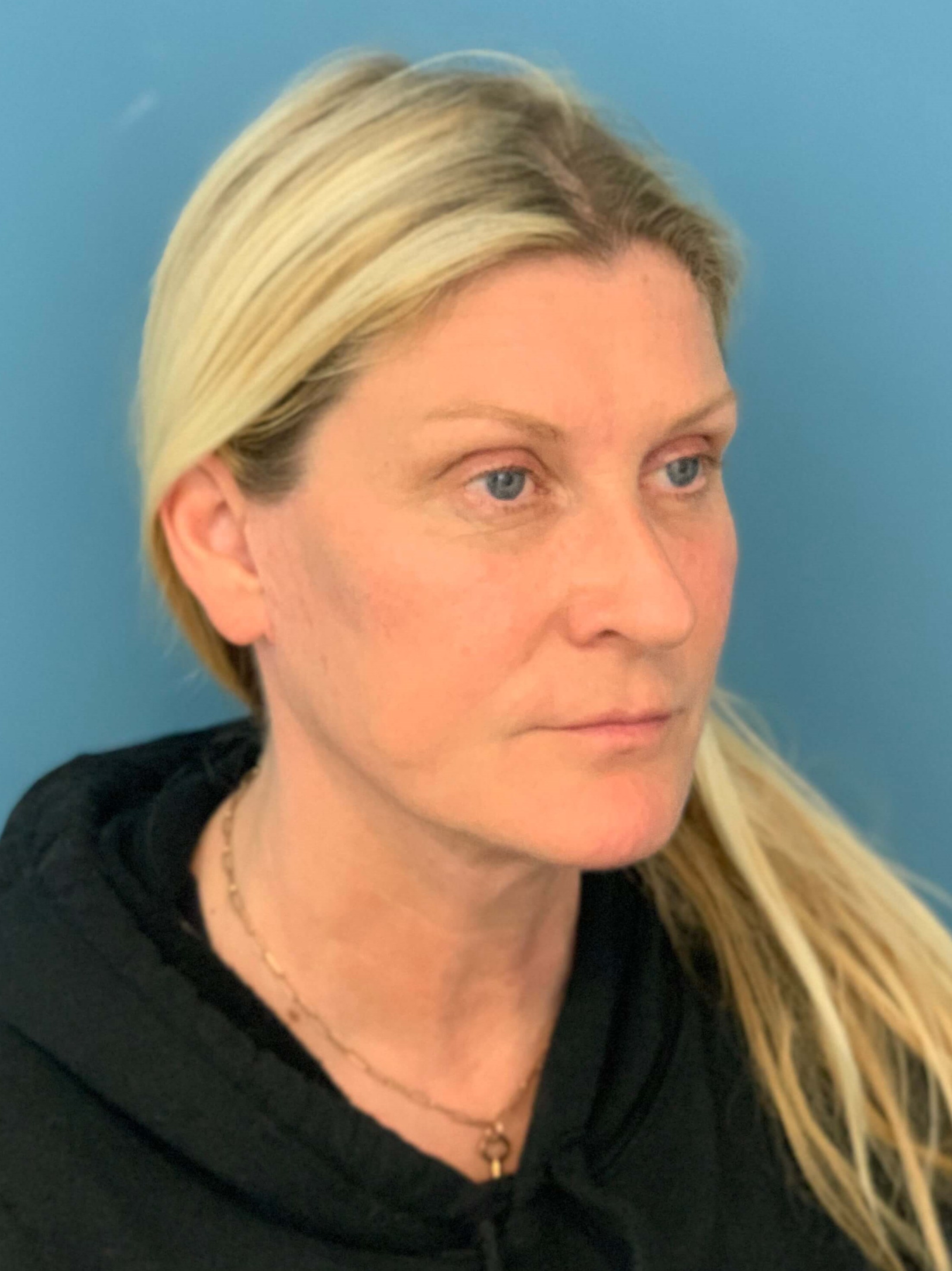 Secondary Lower Face and Neck Lift — after, view 4