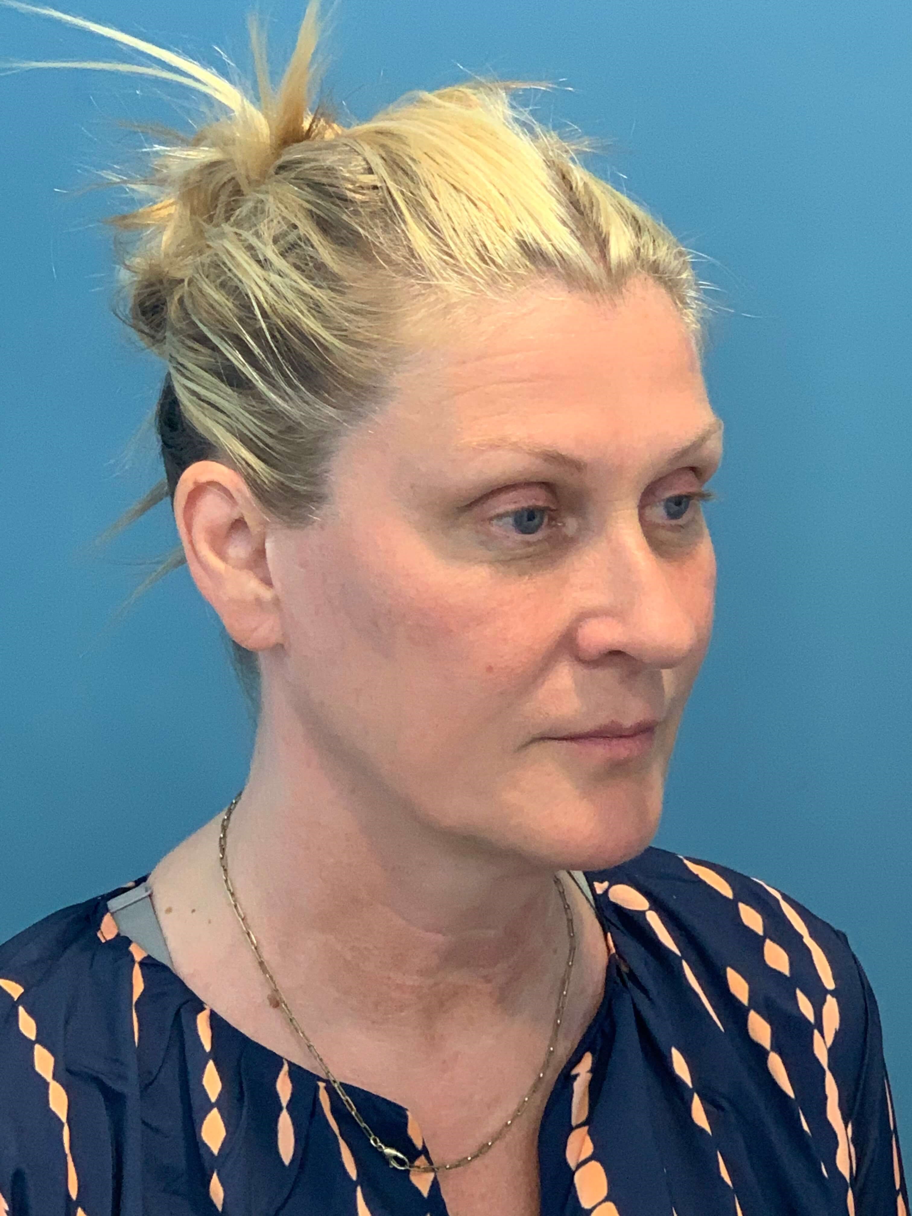 Secondary Lower Face and Neck Lift — before, view 4